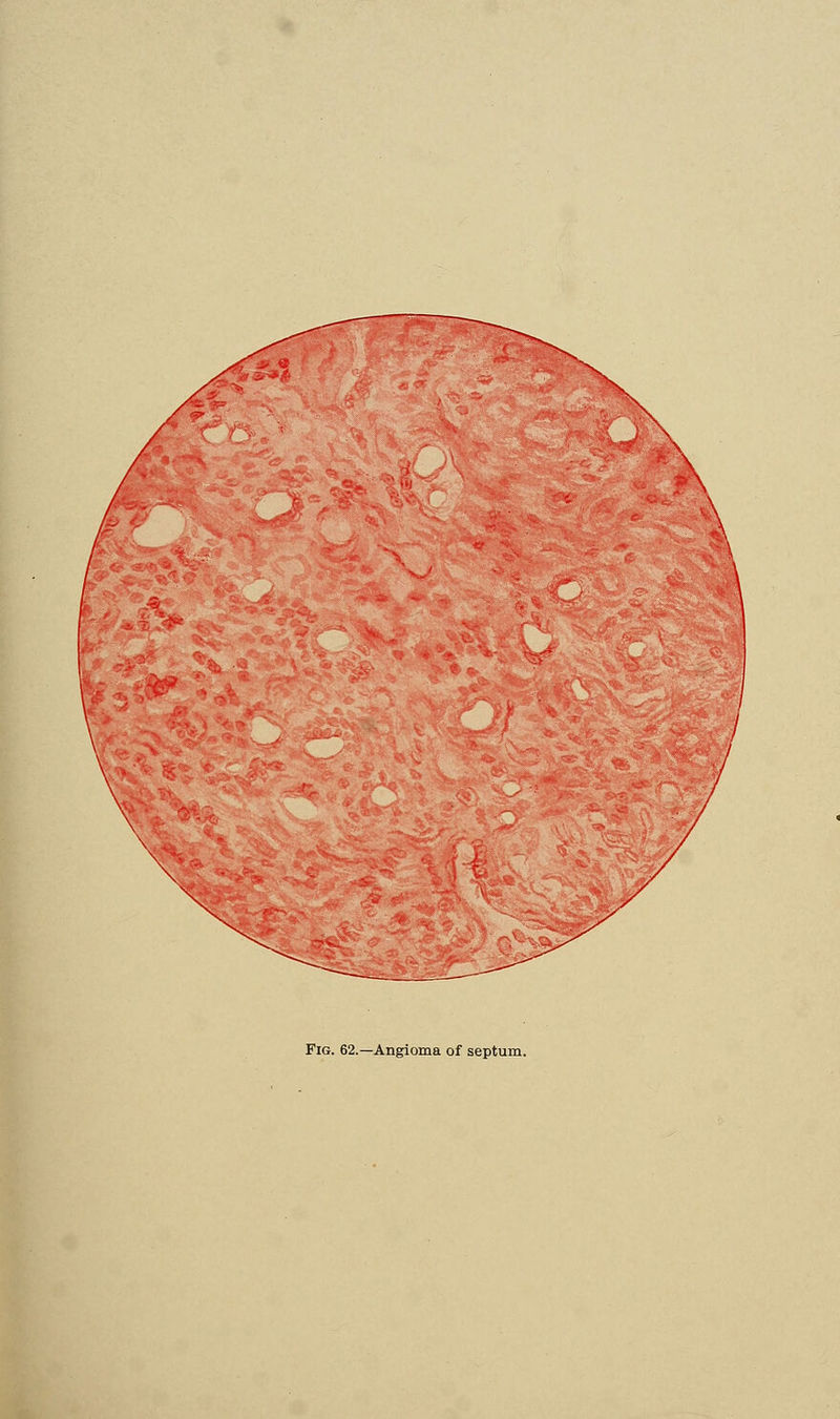 Fig. 62.—Angioma of septum.