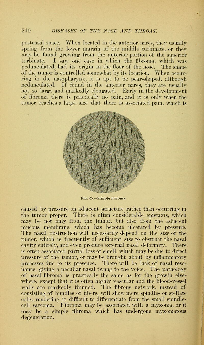 postnasal space. When located in the anterior nares, they usually spring from the lower margin of the middle turbinate, or they may he found growing' from the anterior portion of the superior turbinate. I saw one case in which the fibroma, which was pedunculated, had its origin in the floor of the nose. The shape of the tumor is controlled somewhat by its location. When occur- ring in the nasopharynx, it is apt to be pear-shaped, although pedunculated. If found in the anterior nares, they are usually not so large and markedly elongated. Early in the development of fibroma there is practically no pain, and it is only when the tumor reaches a large size that there is associated pain, which is • • i ',. -.Mi- st- i ?! ',1 is v. *>■ ■'■■' t * -'if JL ■■- J? < I \ty ''V ; > * 'i- • u •■ i ' »•••;■ ■¥.* Fig. 65.—Simple fibroma. caused by pressure on adjacent structure rather than occurring in the tumor proper. There is often considerable epistaxis, which may be not only from the tumor, but also from the adjacent mucous membrane, which has become ulcerated by pressure. The nasal obstruction will necessarily depend on the size of the tumor, which is frequently of sufficient size to obstruct the nasal cavity entirely, and even produce external nasal deformity. There is often associated partial loss of smell, which may be due to direct pressure of the tumor, or may be brought about by inflammatory processes due to its presence. There will be lack of nasal reso- nance, giving a peculiar nasal twang to the voice. The pathology of nasal fibroma is practically the same as for the growth else- where, except that it is often highly vascular and the blood-vessel walls are markedly thinned. The fibrous network, instead of consisting of bundles of fibers, will show more spindle- or stellate cells, rendering it difficult to differentiate from the small spindle- cell sarcoma. Fibroma may be associated with a myxoma, or it may be a simple fibroma which has undergone myxomatous degeneration.