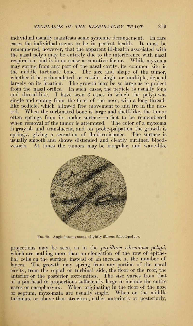 individual usually manifests some systemic derangement. In rare cases the individual seems to be in perfect health. It must be remembered, however, that the apparent ill-health associated with the nasal polyp may be entirely due to the interference with nasal respiration, and is in no sense a causative factor. While myxoma may spring from any part of the nasal cavity, its common site is the middle turbinate bone. The size and shape of the tumor, whether it be pedunculated or sessile, single or multiple, depend largely on its location. The growth may be so large as to project from the nasal orifice. In such cases, the pedicle is usually long and thread-like. I have seen 3 cases in which the polyp was single and sprang from the floor of the nose, with a long thread- like pedicle, which allowed free movement to and fro in the nos- tril. When the turbinated bone is large and shelf-like, the tumor often springs from its under surface—a fact to be remembered when removal of the tumor is attempted. The color of a myxoma is grayish and translucent, and on probe-palpation the growth is springy, giving a sensation of fluid-resistance. The surface is usually smooth and shows distended and clearly outlined blood- vessels. At times the tumors may be irregular, and wave-like Fig. 72 —Angioflbromyxoma, slightly fibrous (blood-polyp). projections may be seen, as in the papillary edematous polypi, which are nothing more than an elongation of the row of epithe- lial cells on the surface, instead of an increase in the number of layers. The growth may spring from any portion of the nasal cavity, from the septal or turbinal side, the floor or the roof, the anterior or the posterior extremities. The size varies from that of a pin-head to proportions sufficiently large to include the entire nares or nasopharynx. When originating in the floor of the nose or septum, myxomata are usually single. When on the middle turbinate or above that structure, either anteriorly or posteriorly,