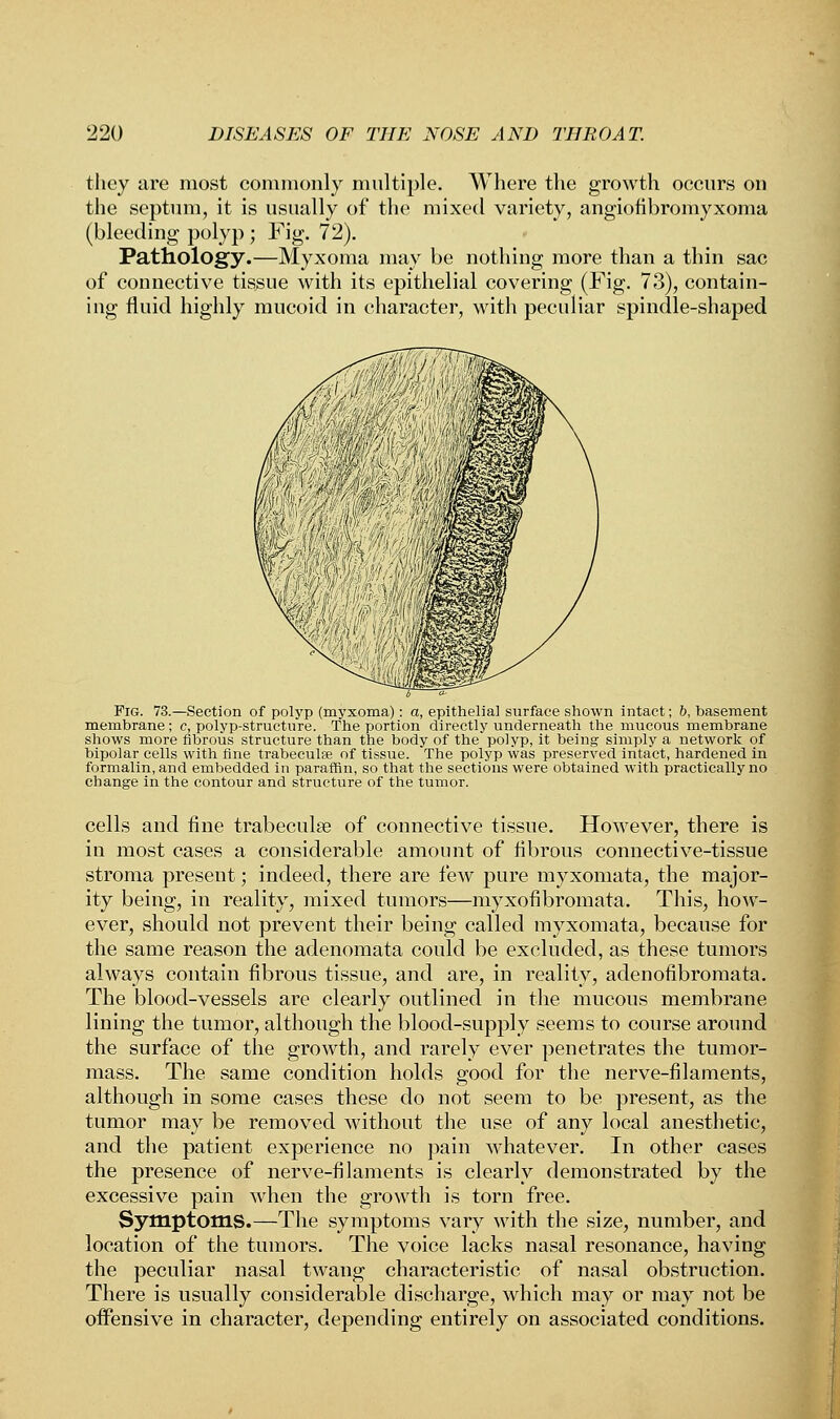 they are most commonly multiple. Where the growth occurs on the septum, it is usually of the mixed variety, angiofibromyxoma (bleeding polyp ; Fig. 72). Pathology.—Myxoma may be nothing more than a thin sac of connective tissue with its epithelial covering (Fig. 73), contain- ing fluid highly mucoid in character, with peculiar spindle-shaped Fig. 73.—Section of polyp (myxoma): a, epithelial surface shown intact; 6, basement membrane ; e, polyp-structure. The portion directly underneath the mucous membrane shows more fibrous structure than the body of the polyp, it being simply a network of bipolar cells with fine trabeculse of tissue. The polyp was preserved inta'ct, hardened in formalin, and embedded in paraffin, so that the sections were obtained with practically no change in the contour and structure of the tumor. cells and fine trabeculse of connective tissue. However, there is in most cases a considerable amount of fibrous connective-tissue stroma present; indeed, there are few pure myxomata, the major- ity being, in reality, mixed tumors—myxofibromata. This, how- ever, should not prevent their being called myxomata, because for the same reason the adenomata could be excluded, as these tumors always contain fibrous tissue, and are, in reality, adenofibromata. The blood-vessels are clearly outlined in the mucous membrane lining the tumor, although the blood-supply seems to course around the surface of the growth, and rarely ever penetrates the tumor- mass. The same condition holds good for the nerve-filaments, although in some cases these do not seem to be present, as the tumor may be removed without the use of any local anesthetic, and the patient experience no pain whatever. In other cases the presence of nerve-filaments is clearly demonstrated by the excessive pain when the growth is torn free. Symptoms.—The symptoms vary with the size, number, and location of the tumors. The voice lacks nasal resonance, having the peculiar nasal twang characteristic of nasal obstruction. There is usually considerable discharge, which may or may not be offensive in character, depending entirely on associated conditions.