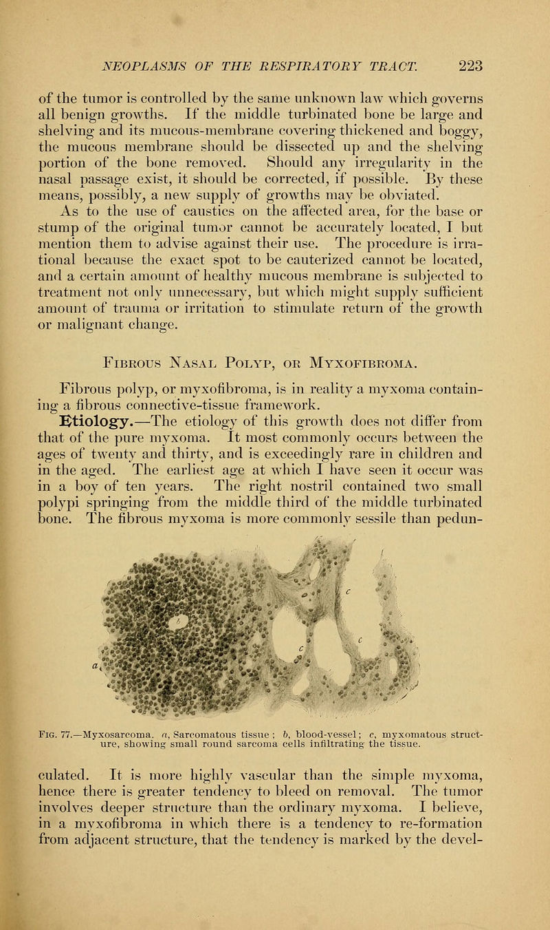 of the tumor is controlled by the same unknown law which governs all benign growths. If the middle turbinated bone be large and shelving and its mucous-membrane covering thickened and boggy, the mucous membrane should be dissected up and the shelving portion of the bone removed. Should any irregularity in the nasal passage exist, it should be corrected, if possible. By these means, possibly, a new supply of growths may be obviated. As to the use of caustics on the affected area, for the base or stump of the original tumor cannot be accurately located, I but mention them to advise against their use. The procedure is irra- tional because the exact spot to be cauterized cannot be located, and a certain amount of healthy mucous membrane is subjected to treatment not only unnecessary, but which might supply sufficient amount of trauma or irritation to stimulate return of the growth or malignant change. Fibrous Nasal Polyp, or Myxofibroma. Fibrous polyp, or myxofibroma, is in reality a myxoma contain- ing a fibrous connective-tissue framework. Etiology.—The etiology of this growth does not differ from that of the pure myxoma. It most commonly occurs between the ages of twenty and thirty, and is exceedingly rare in children and in the aged. The earliest age at which I have seen it occur was in a boy of ten years. The right nostril contained two small polypi springing from the middle third of the middle turbinated bone. The fibrous myxoma is more commonly sessile than pedun- Fig. 77.—Myxosarcoma, a, Sarcomatous tissue ; &, blood-vessel; c, myxomatous struct- ure, showing small round sarcoma cells infiltrating- the tissue. culated. It is more highly vascular than the simple myxoma, hence there is greater tendency to bleed on removal. The tumor involves deeper structure than the ordinary myxoma. I believe, in a myxofibroma in which there is a tendency to re-formation from adjacent structure, that the tendency is marked by the devel-