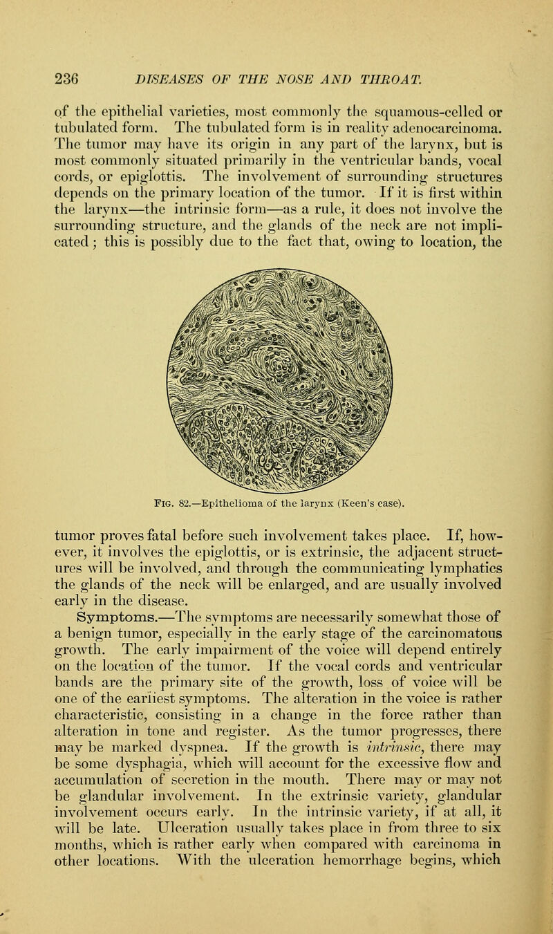 of the epithelial varieties, most commonly the squamous-celled or tubulated form. The tubulated form is in reality adenocarcinoma. The tumor may have its origin in any part of the larynx, but is most commonly situated primarily in the ventricular bands, vocal cords, or epiglottis. The involvement of surrounding structures depends on the primary location of the tumor. If it is first within the larynx—the intrinsic form—as a rule, it does not involve the surrounding structure, and the glands of the neck are not impli- cated ; this is possibly due to the fact that, owing to location, the Fig. 82.—Epithelioma of the larynx (Keen's case). tumor proves fatal before such involvement takes place. If, how- ever, it involves the epiglottis, or is extrinsic, the adjacent struct- ures will be involved, and through the communicating lymphatics the glands of the neck will be enlarged, and are usually involved early in the disease. Symptoms.—The symptoms are necessarily somewhat those of a benign tumor, especially in the early stage of the carcinomatous growth. The early impairment of the voice will depend entirely on the location of the tumor. If the vocal cords and ventricular bands are the primary site of the growth, loss of voice will be one of the earliest symptoms. The alteration in the voice is rather characteristic, consisting in a change in the force rather than alteration in tone and register. As the tumor progresses, there may be marked dyspnea. If the growth is intrinsic, there may be some dysphagia, which will account for the excessive flow and accumulation of secretion in the mouth. There may or may not be glandular involvement. In the extrinsic variety, glandular involvement occurs early. In the intrinsic variety, if at all, it will be late. Ulceration usually takes place in from three to six months, which is rather early when compared with carcinoma in other locations. With the ulceration hemorrhage begins, which