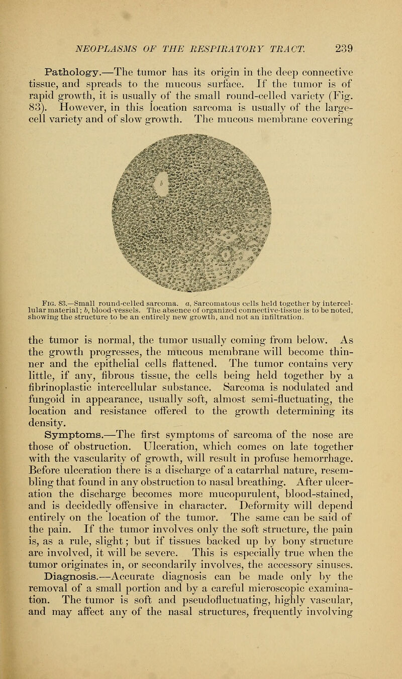 Pathology.—The tumor has its origin in the deep connective tissue, and spreads to the mucous surface. If the tumor is of rapid growth, it is usually of the small round-celled variety (Fig. 83). However, in this location sarcoma is usually of the large- cell variety and of slow growth. The mucous membrane covering Fig. 83.—Small round-celled sarcoma, a, Sarcomatous cells held together by intercel- lular material; b, blood-vessels. The absence of organized connective-tissue is to be noted, showing the structure to be an entirely new growth, and not an infiltration. the tumor is normal, the tumor usually coming from below. As the growth progresses, the mucous membrane will become thin- ner and the epithelial cells flattened. The tumor contains very little, if any, fibrous tissue, the cells being held together by a fibrinoplastic intercellular substance. Sarcoma is nodulated and fungoid in appearance, usually soft, almost semi-fluctuating, the location and resistance offered to the growth determining its density. Symptoms.—The first symptoms of sarcoma of the nose are those of obstruction. Ulceration, which comes on late together with the vascularity of growth, will result in profuse hemorrhage. Before ulceration there is a discharge of a catarrhal nature, resem- bling that found in any obstruction to nasal breathing. After ulcer- ation the discharge becomes more mucopurulent, blood-stained, and is decidedly offensive in character. Deformity will depend entirely on the location of the tumor. The same can be said of the pain. If the tumor involves only the soft structure, the pain is, as a rule, slight; but if tissues backed up by bony structure are involved, it will be severe. This is especially true when the tumor originates in, or secondarily involves, the accessory sinuses. Diagnosis.—Accurate diagnosis can be made only by the removal of a small portion and by a careful microscopic examina- tion. The tumor is soft and pseudofluctuating, highly vascular, and may affect any of the nasal structures, frequently involving
