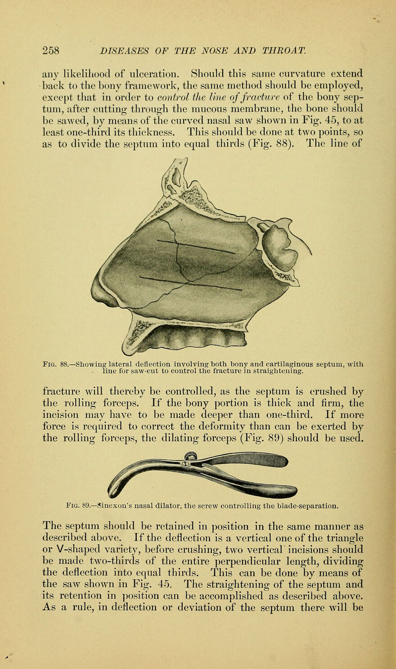 any likelihood of ulceration. Should this same curvature extend back to the bony framework, the same method should be employed, except that in order to control the line of fracture of the bony sep- tum, after cutting through the mucous membrane, the bone should be sawed, by means of the curved nasal saw shown in Fig. 45, to at least one-third its thickness. This should be done at two points, so as to divide the septum into equal thirds (Fig. 88). The line of Fig. 88.—Showing lateral deflection involving both bony and cartilaginous septum, with line for saw-cut to control the fracture in straightening. fracture will thereby be controlled, as the septum is crushed by the rolling forceps. If the bony portion is thick and firm, the incision may have to be made deeper than one-third. If more force is required to correct the deformity than can be exerted by the rolling forceps, the dilating forceps (Fig. 89) should be used. Fig. 89—Sinexon's nasal dilator, the screw controlling the blade-separation. The septum should be retained in position in the same manner as described above. If the deflection is a vertical one of the triangle or V-shaped variety, before crushing, two vertical incisions should be made two-thirds of the entire perpendicular length, dividing the deflection into equal thirds. This can be done by means of the saw shown in Fig. 45. The straightening of the septum and its retention in position can be accomplished as described above. As a rule, in deflection or deviation of the septum there will be