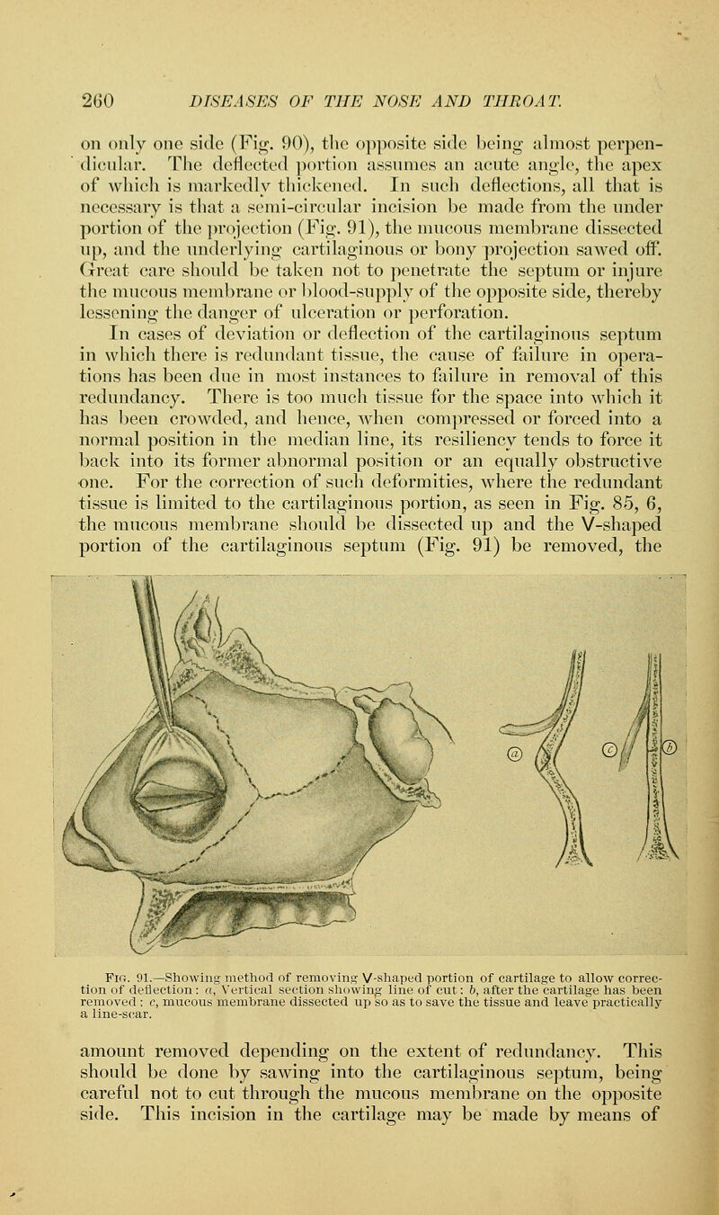 on only one side (Fig. 90), the opposite side being almost perpen- dicular. The deflected portion assumes an acute angle, the apex of which is markedly thickened. In such deflections, all that is necessary is that a semi-circular incision be made from the under portion of the projection (Fig. 91), the mucous membrane dissected up, and the underlying cartilaginous or bony projection sawed off. Great care should be taken not to penetrate the septum or injure the mucous membrane or blood-supply of the opposite side, thereby lessening the danger of ulceration or perforation. In cases of deviation or deflection of the cartilaginous septum in which there is redundant tissue, the cause of failure in opera- tions has been due in most instances to failure in removal of this redundancy. There is too much tissue for the space into which it has been crowded, and hence, when compressed or forced into a normal position in the median line, its resiliency tends to force it back into its former abnormal position or an equally obstructive one. For the correction of such deformities, where the redundant tissue is limited to the cartilaginous portion, as seen in Fig. 85, 6, the mucous membrane should be dissected up and the V-shaped portion of the cartilaginous septum (Fig. 91) be removed, the Fir. 91.—Showing method of removing: V-shaped portion of cartilage to allow correc- tion of deflection : a, Vertical section showing line of cut: b, after the cartilage has been removed : c, mucous membrane dissected up so as to save the tissue and leave practically a line-scar. amount removed depending on the extent of redundancy. This should be done by sawing into the cartilaginous septum, being careful not to cut through the mucous membrane on the opposite side. This incision in the cartilage may be made by means of