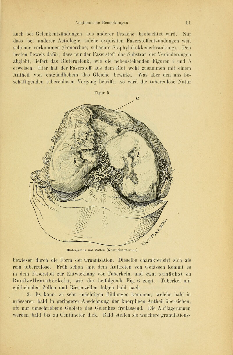 auch bei Gelenkentzündungen aus anderer Ursache beobachte! wird. Nur dass bei anderer Aetiologie solche exquisiten Faserstoffentzündungen weit seltener vorkommen (Gonorrhoe, subacute Staphylokokkenerkrankung). Den besten Beweis dafür, dass nur der Faserstott' das .Substrat der Veränderungen abgiebt, liefert das Blutergelenk, wie die nebenstehenden Figuren 4 und 5 erweisen. Hier hat der Faserstoff aus dem Blut wohl zusammen mit einem Antheil von entzündlichem das Gleiche bewirkt. Was aber den uns be- schäftigenden tuberculösen Vorgang betrifft, so wird die tuberculöse Natur Figur 5. a Blntetgelenk mit Zotten (Knorpelzerstörung). bewiesen durch die Form der Organisation. Dieselbe charakterisirt sich als rein tuberculöse. Früh schon mit dem Auftreten von Gefässen kommt es in dem Faserstoff zur Entwicklung von Tuberkeln, und zwar zunächst zu Rundzellentuberkeln, wie die beifolgende Fig. 6 zeigt. Tuberkel mit epitheloiden Zellen und Riesenzellen folgen bald nach. 2. Es kann zu sehr mächtigen Bildungen kommen, welche bald in grösserer, bald in geringerer Ausdehnung den knorpligen Antheil überziehen, oft nur umschriebene Gebiete des Gelenkes freilassend. Die Auflagerungen werden bald bis zu Centimeter dick. Bald stellen sie weichere granulations-