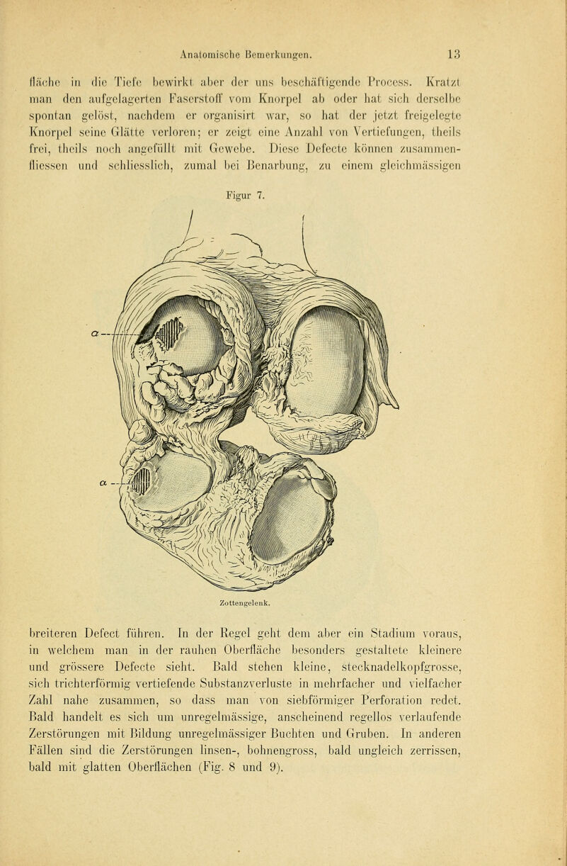 flache in die Tiefe bewirk! aber der uns beschäftigende Process. Kraizt man den aufgelagerten Faserstoff vom Knorpel ab oder hat sich derselbe spontan gelöst, nachdem er organisirt war, so hat der jetzt freigelegte Knorpel seine Glätte verloren; er zeigt eine Anzahl von Vertiefungen, thcils frei, theils noch angefüllt mit Gewebe. Diese Defectc können zusammen- ilicssen und schliesslich, zumal bei Benarbung, zu einem glcichmässigcn Figur 7. a- Zottengelenk. breiteren Defect führen. In der Regel geht dem aber ein Stadium voraus, in welchem man in der rauhen Oberfläche besonders gestaltete kleinere und grössere Defecte sieht. Bald stehen kleine, stecknadelkopfgrosse, sich trichterförmig vertiefende Substanzverluste in mehrfacher und vielfacher Zahl nahe zusammen, so dass man von siebförmiger Perforation redet. Bald handelt es sich um unregelmässige, anscheinend regellos verlaufende Zerstörungen mit Bildung unregelmässiger Buchten und Gruben. In anderen Fällen sind die Zerstörungen linsen-, bohnengross, bald ungleich zerrissen, bald mit glatten Oberflächen (Fig. 8 und 9).