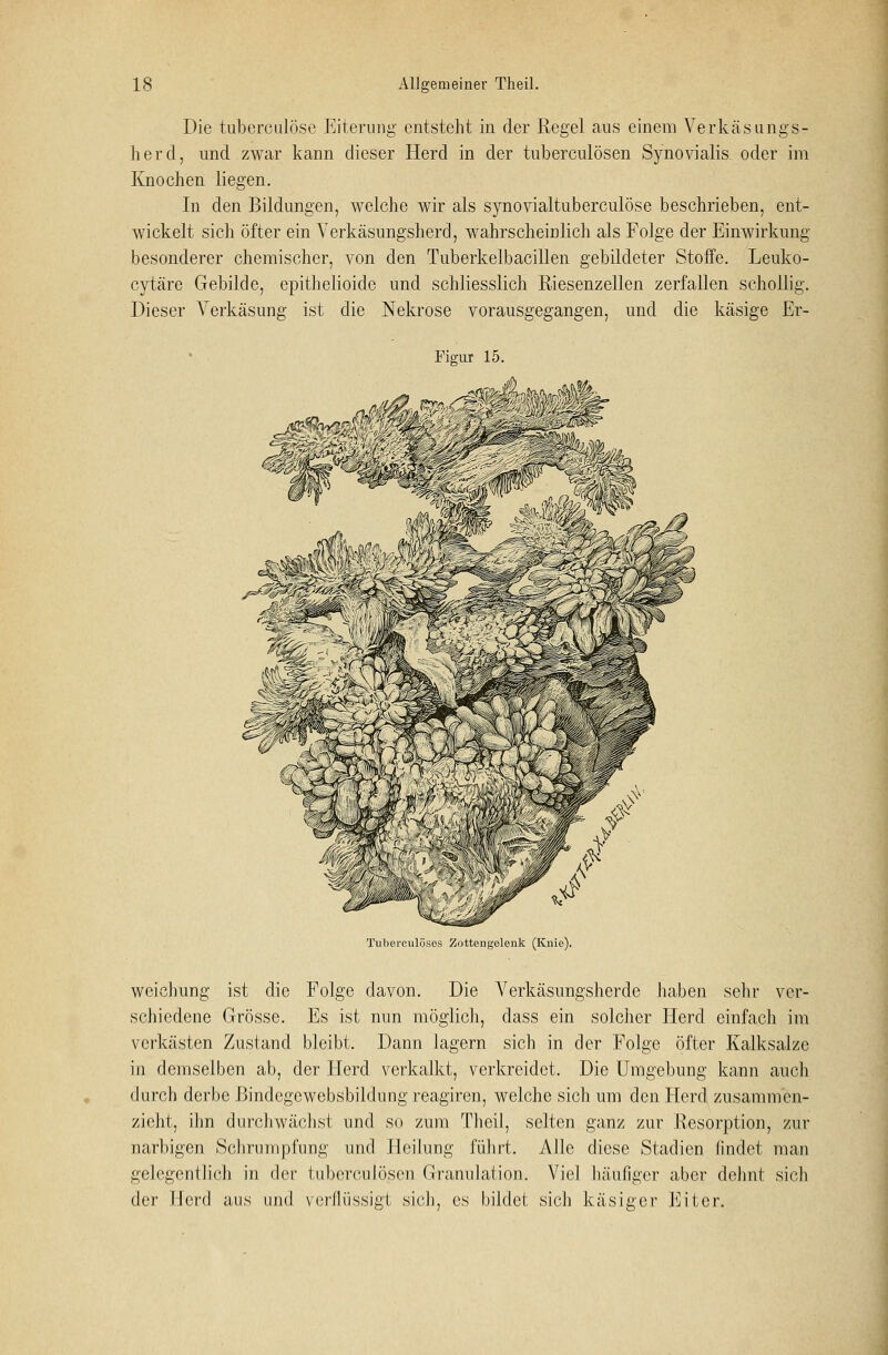 Die tuberculöse Eiterung entsteht in der Regel ans einem Verkäsungs- herd, und zwar kann dieser Herd in der tuberculösen Synovialis, oder im Knochen liegen. In den Bildungen, welche wir als synovialtuberculöse beschrieben, ent- wickelt sich öfter ein Verkäsungsherd, wahrscheinlich als Folge der Einwirkung besonderer chemischer, von den Tuberkelbacillen gebildeter Stoffe. Leuko- cytäre Gebilde, epithelioide und schliesslich Riesenzellen zerfallen schollig. Dieser Verkäsung ist die Nekrose vorausgegangen, und die käsige Er- Figur 15. ^Ä^V^l»! Tuberculöses Zottengelenk (Knie). weichung ist die Folge davon. Die Verkäsungsherde haben sehr ver- schiedene Grösse. Es ist nun möglich, dass ein solcher Herd einfach im verkästen Zustand bleibt. Dann lagern sich in der Folge öfter Kalksalze in demselben ab, der Herd verkalkt, verkreidet. Die Umgebung kann auch durch derbe Bindegewebsbildung reagiren, welche sich um den Herd zusammen- zieht, ihn durchwächst und so zum Theil, selten ganz zur Resorption, zur narbigen Schrumpfung und Heilung führt. Alle diese Stadien findet mau gelegentlich in der tuberculösen Granulation. Viel häufiger aber dehnt sich der Herd aus und verflüssigt sich, es bildet sich käsiger Eiter.