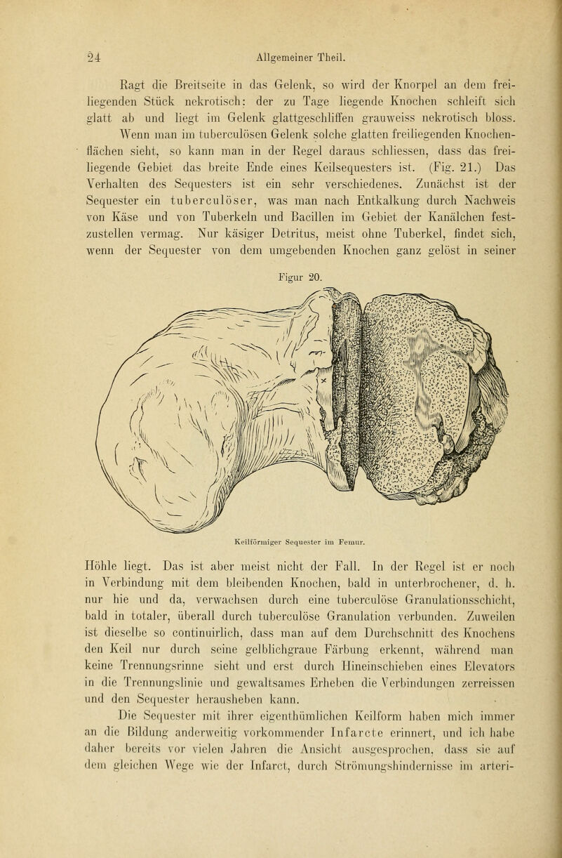 Ragt die Breitseite in das Gelenk, so wird der Knorpel an dem frei- liegenden Stück nekrotisch; der zu Tage liegende Knochen schleift sich glatt ab und liegt im Gelenk glattgeschliffen grauweiss nekrotisch bloss. Wenn man im tuberculösen Gelenk solche glatten freiliegenden Knochen- flächen sieht, so kann man in der Regel daraus schliessen, dass das frei- liegende Gebiet das breite Ende eines Keilsequesters ist. (Fig. 21.) Das Verhalten des Sequesters ist ein sehr verschiedenes. Zunächst ist der Sequester ein tuberculöser, was man nach Entkalkung durch Nachweis von Käse und von Tuberkeln und Bacillen im Gebiet der Kanälchen fest- zustellen vermag. Nur käsiger Detritus, meist ohne Tuberkel, findet sich, wenn der Sequester von dem umgebenden Knochen ganz gelöst in seiner Figur 20. Keilförmiger Sequester im Femur. Höhle liegt. Das ist aber meist nicht der Fall. In der Regel ist er noch in Verbindung mit dem bleibenden Knochen, bald in unterbrochener, d. h. nur hie und da, verwachsen durch eine tuberculöse Granulationsschicht, bald in totaler, überall durch tuberculöse Granulation verbunden. Zuweilen ist dieselbe so continuirlich, dass man auf dem Durchschnitt des Knochens den Keil nur durch seine gelblichgraue Färbung erkennt, während man keine Trennungsrinne sieht und erst durch Hineinschieben eines Elevators in die Trennungslinie und gewaltsames Erheben die Verbindungen zerreissen und den Sequester herausheben kann. Die Sequester mit ihrer eigentümlichen Keilform haben mich immer an die Bildung anderweitig vorkommender Infarcte erinnert, und ich hatte daher bereits vor vielen Jahren die Ansicht ausgesprochen, dass sie auf dem gleichen Wege wie der [nfaret, durch Strömungshindernisse im arteri-