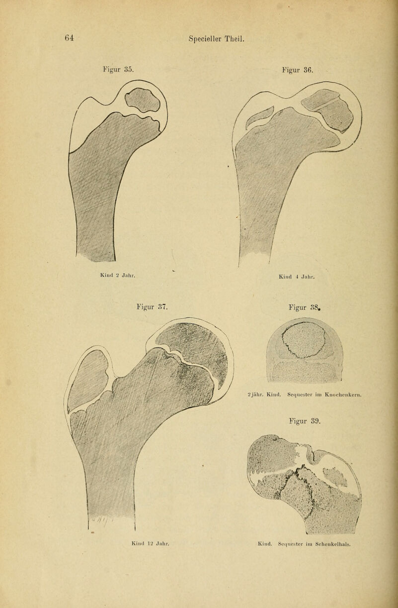 Figur 36. I Kind i Jahr. Figur 37. Figur 38. // . ' )' VIV £/ ./ 2jähr. Kind. Sequester im Knockeukern. Figur 39. \ \0ff0mkS i Kind 12 Jah Kind. Sequester im .Sehenkelhals.
