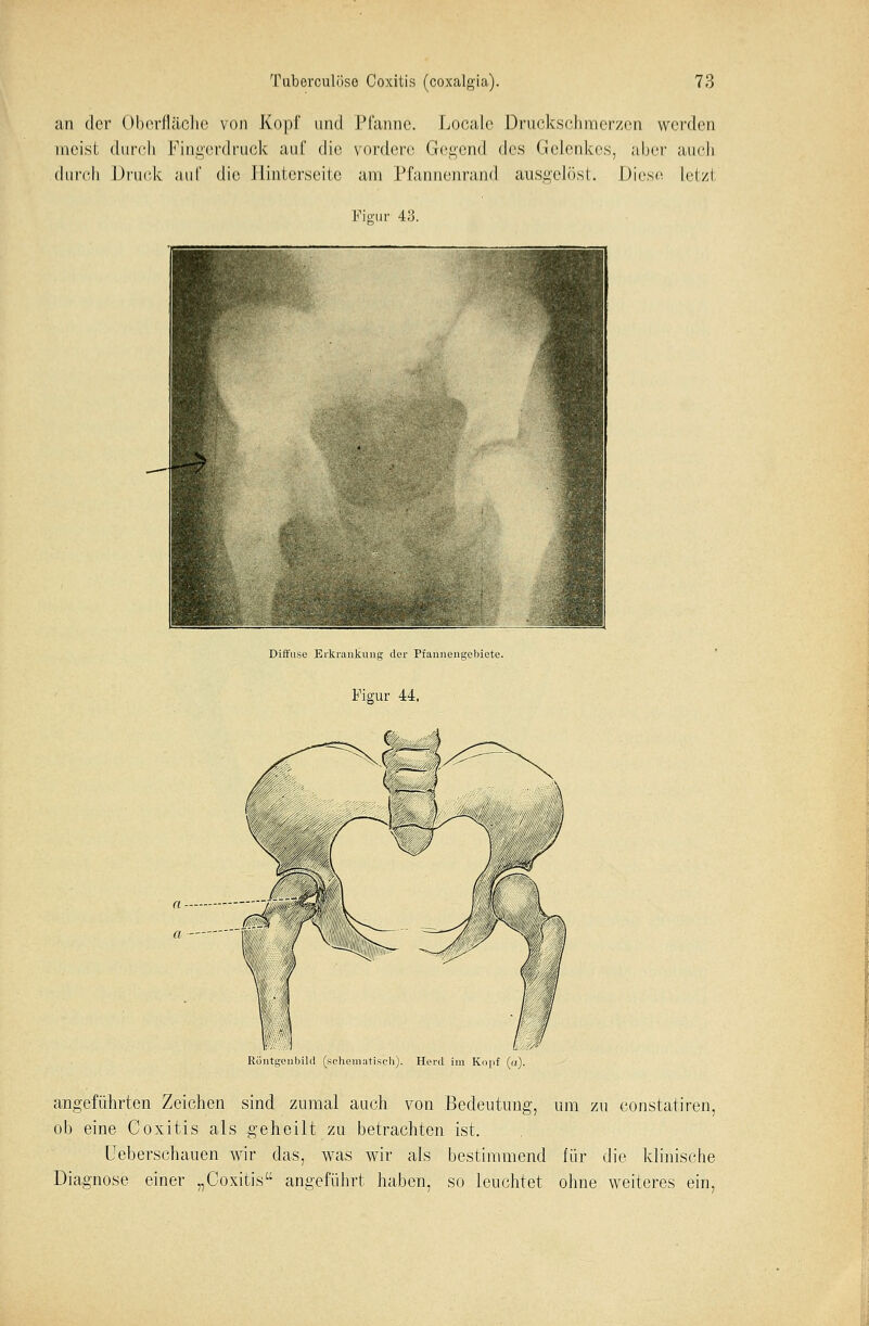 an der Oberfläche von Kopf und Pfanne. Locale Druckschmerzen werden meist; durch Fingerdruck auf die vordere Gegend des Gelenkes, aber auch durch Druck auf die Hinterseite am Pfannenrand ausgelöst. Diese Letzt Figur 43. Diffuse Erkrankung der Pfannengebiete. Figur 44. Röntgenbild (schematisch). Herd im Kopf (a). angeführten Zeichen sind zumal auch von Bedeutung, um zu eonstatiren, ob eine Coxitis als geheilt zu betrachten ist. Ueberschauen wir das, was wir als bestimmend für die klinische Diagnose einer „Coxitis angeführt haben, so leuchtet ohne weiteres ein,