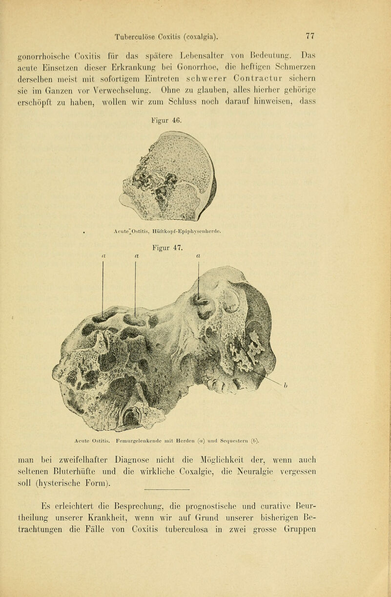 gonorrhoische Coxitis für das spätere Lebensalter von Bedeutung. Das acute Einsetzen dieser Erkrankung bei Gonorrhoe, die heftigen Schmerzen derselben meist mit sofortigem Eintreten schwerer Contractur siehern sie im Ganzen vor Verwechselung. Ohne zu glauben, alles hierher gehörige erschöpft zu haben, wollen wir zum Schluss noch darauf hinweisen, dass Figur 46. Acute'Ostitis, Hüftkopf-Epiphysonherde. Acute Ostitis. Femurgelenkende mit Herden (a) und Sequestern (b). man bei zweifelhafter Diagnose nicht die Möglichkeit der, wenn auch seltenen Bluterhüfte und die wirkliche Coxalgie, die Neuralgie vergessen soll (hysterische Form). Es erleichtert die Besprechung, die prognostische und curative Beur- theilung unserer Krankheit, wenn wir auf Grund unserer bisherigen Be- trachtungen die Fälle von Coxitis tuberculosa in zwei grosse Gruppen