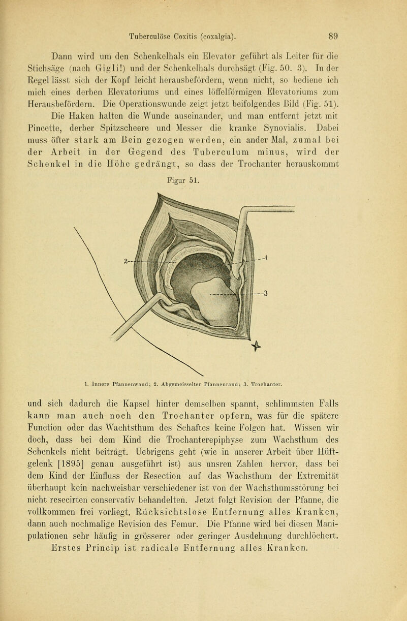 Dann wird um den Schenkelhals ein Elevator geführt als Leiter für die Stichsäge (nach Gigli!) und der Schenkelhals durchsägt (Fig. 50. 3). Inder Hegel lässt sich der Kopf leicht herausbefördern, wenn nicht, so bediene ich mich eines derben Elevatoriums und eines löffeiförmigen Elevatoriums zum Herausbefördern. Die Operationswunde zeigt jetzt beifolgendes Bild (Fig. 51). Die Haken halten die Wunde auseinander, und man entfernt jetzt mit Pincette, derber Spitzscheere und Messer die kranke Synovialis. Dabei muss öfter stark am Bein gezogen werden, ein ander Mal, zumal bei der Arbeit in der Gegend des Tuberculum minus, wird der Schenkel in die Höhe gedrängt, so dass der Trochanter herauskommt Figur 51. 1. Innere Pfannenwand; 2. Abgemeisselter Ptannenrand; 3. Trochanter. und sich dadurch die Kapsel hinter demselben spannt, schlimmsten Falls kann man auch noch den Trochanter opfern, was für die spätere Function oder das Wachtsthum des Schaftes keine Folgen hat. Wissen wir doch, dass bei dem Kind die Trochanterepiphyse zum Wachsthum des Schenkels nicht beiträgt. Uebrigens geht (wie in unserer Arbeit über Hüft- gelenk [1895] genau ausgeführt ist) aus unsren Zahlen hervor, dass bei dem Kind der Einfluss der Resection auf das Wachsthum der Extremität überhaupt kein nachweisbar verschiedener ist von der Wachsthumsstörung bei nicht resecirten conservativ behandelten. Jetzt folgt Revision der Pfanne, die vollkommen frei vorliegt. Rücksichtslose Entfernung alles Kranken, dann auch nochmalige Revision des Femur. Die Pfanne wird bei diesen Mani- pulationen sehr häufig in grösserer oder geringer Ausdehnung durchlöchert. Erstes Princip ist radicale Entfernung alles Kranken.