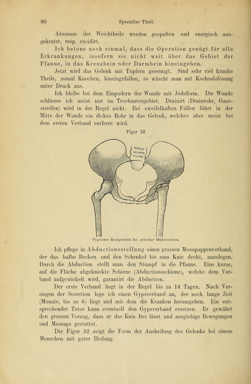 Abscesse der Weichtheile werden gespalten und energisch aus- gekratzt, resp. excidirt. Ich betone noch einmal, dass die Operation genügt für alle Erkrankungen, insofern sie nicht weit über das Gebiet der Pfanne, in das Kreuzbein oder Darmbein hineingehen. Jetzt wird das Gelenk mit Tupfern gereinigt. Sind sehr viel kranke Theile, zumal Knochen, hineingefallen, so wäscht man mit Kochsalzlösung unter Druck aus. Ich bleibe bei dem Einpudern der Wunde mit Jodoform. Die Wunde schliesse ich meist nur im Trochantergebiet. Drainirt (Drainrohr, Gaze- streifen) wird in der Regel nicht. Bei zweifelhaften Fällen führt in der Mitte der Wunde ein dickes Rohr in das Gelenk, welches aber meist bei dem ersten Verband entfernt wird. Figur 52. Typisches Röntgenbild bei geheilter Hüftresection. Ich pflege in Abductionsstellung einen grossen Moospappenverband, der das halbe Becken und den Schenkel bis zum Knie deckt, anzulegen. Durch die Abduction stellt man den Stumpf in die Pfanne. Eine kurze, auf die Fläche abgeknickte Schiene (Abcluctionsschiene), welche dem Ver- band aufgewickelt wird, garantirt die Abduction. Der erste Verband liegt in der Regel bis zu 14 Tagen. Nach Ver- siegen der Secretion lege ich einen Gypsverband an, der noch lange Zeit (Monate, bis zu 6) liegt und mit dem die Kranken herumgehen. Ein ent- sprechender Tutor kann eventuell den Gypsverband ersetzen. Er gewährt den grossen Vorzug, dass er das Knie frei lässt und ausgiebige Bewegungen und Massage gestattet. Die Figur 52 zeigt die Form der Ausheilung des Gelenks bei einem Menschen mit guter Heilung.