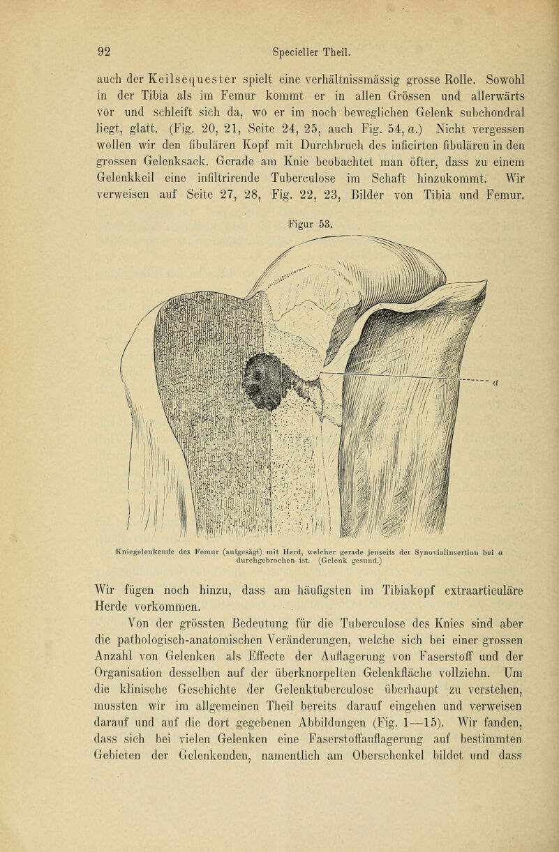 auch der Keilsequester spielt eine verhältnissmässig grosse Rolle. Sowohl in der Tibia als im Femur kommt er in allen Grössen und allerwärts vor und schleift sich da, wo er im noch beweglichen Gelenk subchondral liegt, glatt. (Fig. 20, 21, Seite 24, 25, auch Fig. 54, a.) Nicht vergessen wollen wir den fibulären Kopf mit Durchbruch des inficirten fibulären in den grossen Gelenksack. Gerade am Knie beobachtet man öfter, dass zu einem Gelenkkeil eine infiltrirende Tuberculose im Schaft hinzukommt. Wir verweisen auf Seite 27, 28, Fig. 22, 23, Bilder von Tibia und Femur. Figur 53. Kniegelenkende des Femur (aufgesägt) mit Herd, welcher gerade jenseits der SynoviaHnsertion bei a durchgebrochen ist. (Gelenk gesund.) Wir fügen noch hinzu, dass am häufigsten im Tibiakopf extraarticuläre Herde vorkommen. Von der grössten Bedeutung für die Tuberculose des Knies sind aber die pathologisch-anatomischen Veränderungen, welche sich bei einer grossen Anzahl von Gelenken als Effecte der Auflagerung von Faserstoff und der Organisation desselben auf der überknorpelten Gelenkfläche vollziehn. Um die klinische Geschichte der Gelenktuberculose überhaupt zu verstehen, mussten wir im allgemeinen Theil bereits darauf eingehen und verweisen darauf und auf die dort gegebenen Abbildungen (Fig. 1—15). Wir fanden, dass sich bei vielen Gelenken eine Faserstoffauflagerung auf bestimmten Gebieten der Gclcnkendcn, namentlich am Oberschenkel bildet und dass
