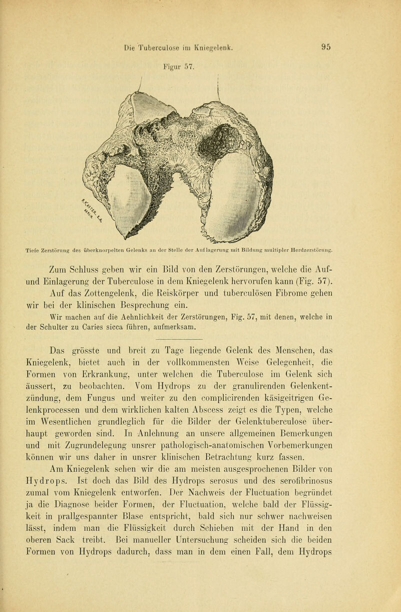 Figur 57. Tiefe Zerstörung des überknorpelten Gelenks an der Stelle der Auflagerung mit Bildung multipler Herdzerstörung. Zum Schluss geben wir ein Bild von den Zerstörungen, welche die Auf- und Einlagerung der Tuberculose in dem Kniegelenk hervorufen kann (Fig. 57). Auf das Zottengelenk, die Reiskörper und tuberculösen Fibrome gehen wir bei der klinischen Besprechung ein. Wir machen auf die Aehnlichkeit der Zerstörungen, Fig. 57, mit denen, welche in der Schulter zu Caries sicca führen, aufmerksam. Das grösste und breit zu Tage liegende Gelenk des Menschen, das Kniegelenk, bietet auch in der vollkommensten Weise Gelegenheit, die Formen von Erkrankung, unter welchen die Tuberculose im Gelenk sich äussert, zu beobachten. Vom Hydrops zu der granulirenden Gelenkent- zündung, dem Fungus und weiter zu den complicirenden käsigeitrigen Ge- lenkprocessen und dem wirklichen kalten Abscess zeigt es die Typen, welche im Wesentlichen grundleglich für die Bilder der Gelenktuberculose über- haupt geworden sind. In Anlehnung an unsere allgemeinen Bemerkungen und mit Zugrundelegung unsrer pathologisch-anatomischen Vorbemerkungen können wir uns daher in unsrer klinischen Betrachtung kurz fassen. Am Kniegelenk sehen wir die am meisten ausgesprochenen Bilder von Hydrops. Ist doch das Bild des Hydrops serosus und des serofibrinosus zumal vom Kniegelenk entworfen. Der Nachweis der Fluctuation begründet ja die Diagnose beider Formen, der Fluctuation, welche bald der Flüssig- keit in prallgespannter Blase entspricht, bald sich nur schwer nachweisen lässt, indem man die Flüssigkeit durch Schieben mit der Hand in den oberen Sack treibt, Bei manueller Untersuchung scheiden sich die beiden Formen von Hydrops dadurch, dass man in dem einen Fall, dem Hydrops