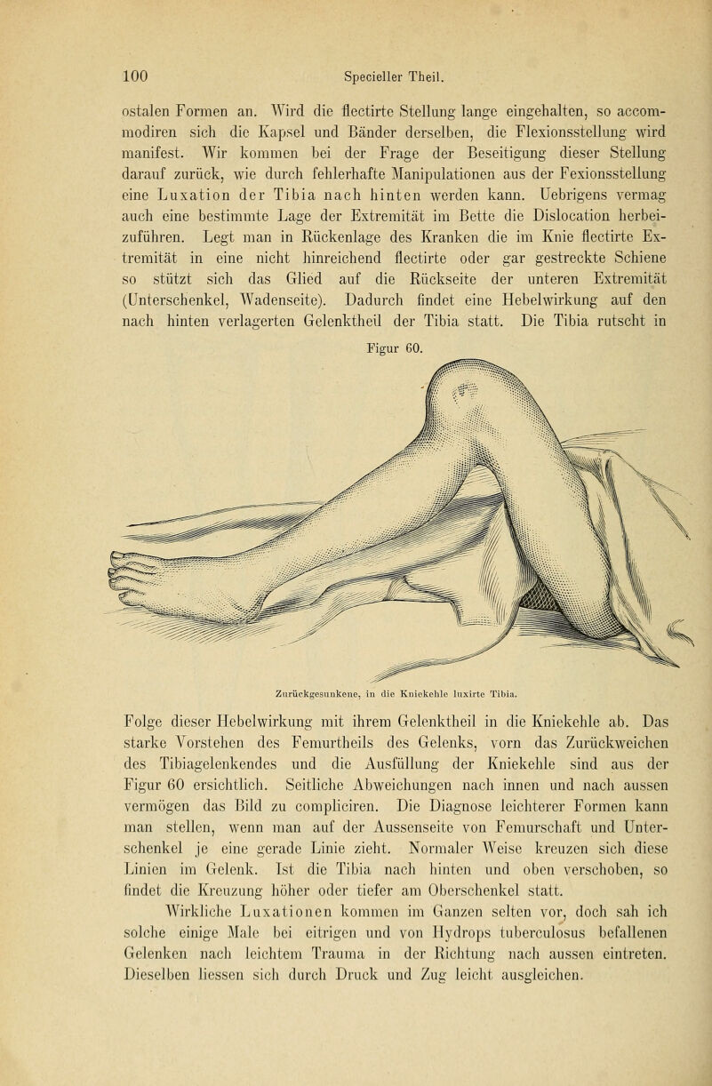 ostalen Formen an. Wird die flectirte Stellung lange eingehalten, so accom- raodiren sich die Kapsel und Bänder derselben, die Flexionsstellung wird manifest. Wir kommen bei der Frage der Beseitigung dieser Stellung darauf zurück, wie durch fehlerhafte Manipulationen aus der Fexionsstellung eine Luxation der Tibia nach hinten werden kann. Uebrigens vermag auch eine bestimmte Lage der Extremität im Bette die Dislocation herbei- zuführen. Legt man in Rückenlage des Kranken die im Knie flectirte Ex- tremität in eine nicht hinreichend flectirte oder gar gestreckte Schiene so stützt sich das Glied auf die Rückseite der unteren Extremität (Unterschenkel, Wadenseite). Dadurch findet eine Hebelwirkung auf den nach hinten verlagerten Gelenktheil der Tibia statt. Die Tibia rutscht in Figur 60. Zurückgesunkene, in die Kniekehle lnxirte Tibia. Folge dieser Hebelwirkung mit ihrem Gelenktheil in die Kniekehle ab. Das starke Vorstehen des Femurtheils des Gelenks, vorn das Zurückweichen des Tibiagelenkendes und die Ausfüllung der Kniekehle sind aus der Figur 60 ersichtlich. Seitliche Abweichungen nach innen und nach aussen vermögen das Bild zu compliciren. Die Diagnose leichterer Formen kann man stellen, wenn man auf der Aussenseite von Femurschaft und Unter- schenkel je eine gerade Linie zieht. Normaler Weise kreuzen sich diese Linien im Gelenk. Ist die Tibia nach hinten und oben verschoben, so findet die Kreuzung höher oder tiefer am Oberschenkel statt. Wirkliche Luxationen kommen im Ganzen selten vor, doch sah ich solche einige Male bei eitrigen und von Hydrops tuberculosus befallenen Gelenken nach leichtem Trauma in der Richtung nach aussen eintreten. Dieselben Hessen sich durch Druck und Zug leicht ausgleichen.