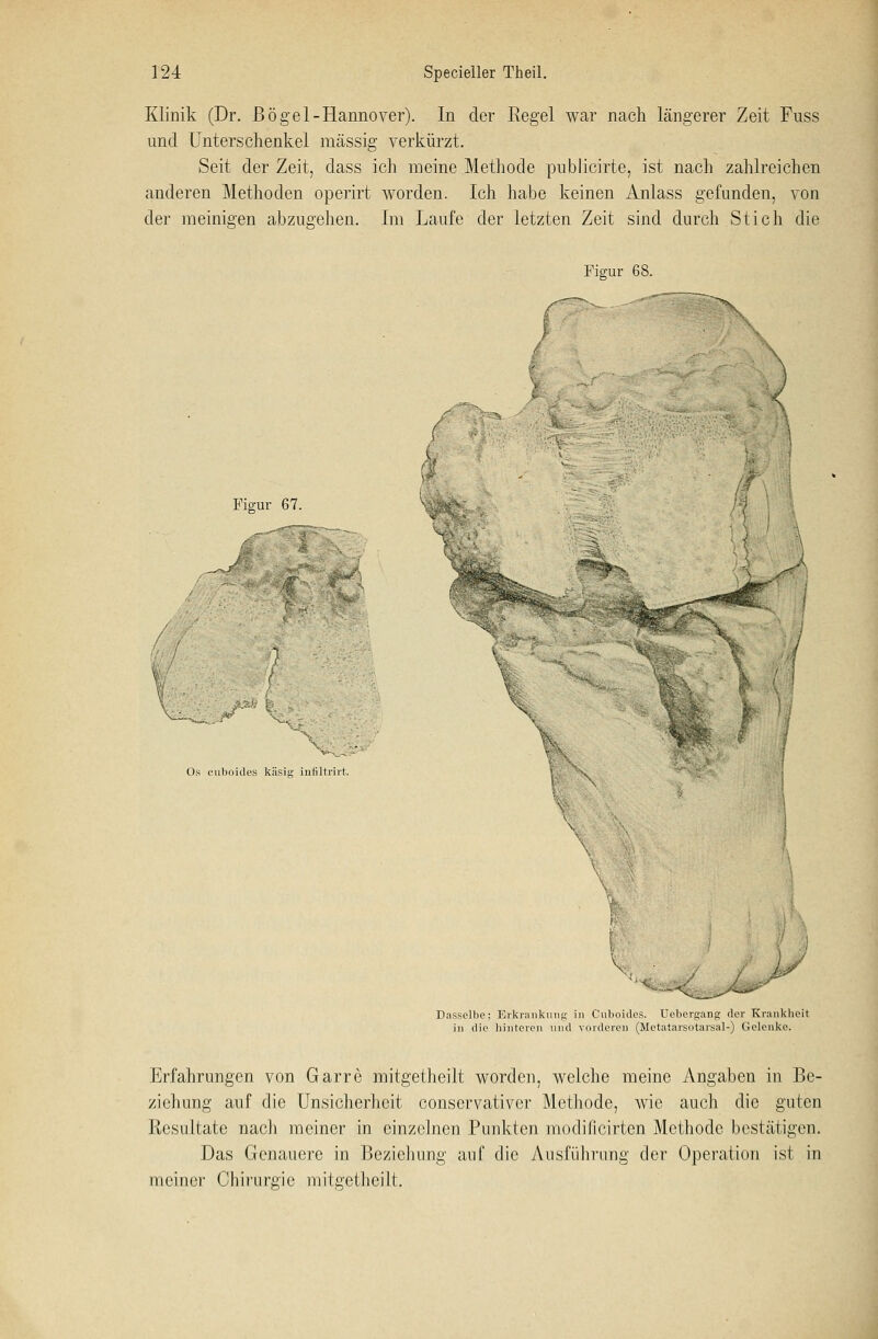 Klinik (Dr. ßö gel-Hannover). In der Regel war nach längerer Zeit Fuss und Unterschenkel massig verkürzt. Seit der Zeit, dass ich meine Methode publicirte, ist nach zahlreichen anderen Methoden operirt worden. Ich habe keinen Anlass gefunden, von der meinigen abzusehen. Im Laufe der letzten Zeit sind durch Stich die Figur 68. Figur 67. \ X V Os euboides käsig infiltrirt. Dasselbe; Erkrankung in Cuboidcs. Uebergang der Krankheit in die hinteren und vorderen (Metatarsotarsal-) Gelenke. Erfahrungen von Garre mitgetheilt worden, welche meine Angaben in Be- ziehung auf die Unsicherheit conservativer Methode, wie auch die guten Resultate nach meiner in einzelnen Punkten modificirten Methode bestätigen. Das Genauere in Beziehung auf die Ausführung der Operation ist in meiner Chirurgie mitgetheilt.