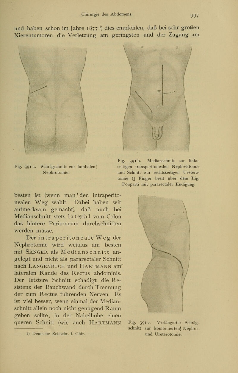 und haben schon im Jahre 1877 *■) dies empfohlen, daß bei sehr großen Nierentumoren die Verletzung am geringsten und der Zugang am \ w Fig. 391a. Schrägschnitt zur lumbalen' Nephrotomie. Fig- 39ib. Medianschnitt zur links- seitigen transperitonealen Nephrektomie und Schnitt zur rechtsseitigen Uretero- tomie (3 Finger breit über dem ;Lig. Pouparti mit pararectaler Endigung. besten ist, iwenn man j den intraperito- nealen Weg wählt. Dabei haben wir aufmerksam gemacht], daß auch bei Medianschnitt stets lateir|al vom Colon das hintere Peritoneum durchschnitten werden müsse. Der intraperitoneale Weg der Nephrotomie wird weitaus am besten mit Sänger als Medianschnitt an- gelegt und nicht als pararectaler Schnitt nach Langenbuch und Hartmann am' lateralen Rande des Rectus abdominis. Der letztere Schnitt schädigt die Re- sistenz der Bauchwand durch Trennung der zum Rectus führenden Nerven. Es ist viel besser, wenn einmal der Median- schnitt allein noch nicht genügend Raum geben sollte, in der Nabelhöhe einen queren Schnitt (wie auch HARTMANN V 1) Deutsche Zeitschr. f. Chir. Fig. 391 c. Verlängerter Schräg- schnitt zur kombinierten^ Nephro- und Ureterotomie.