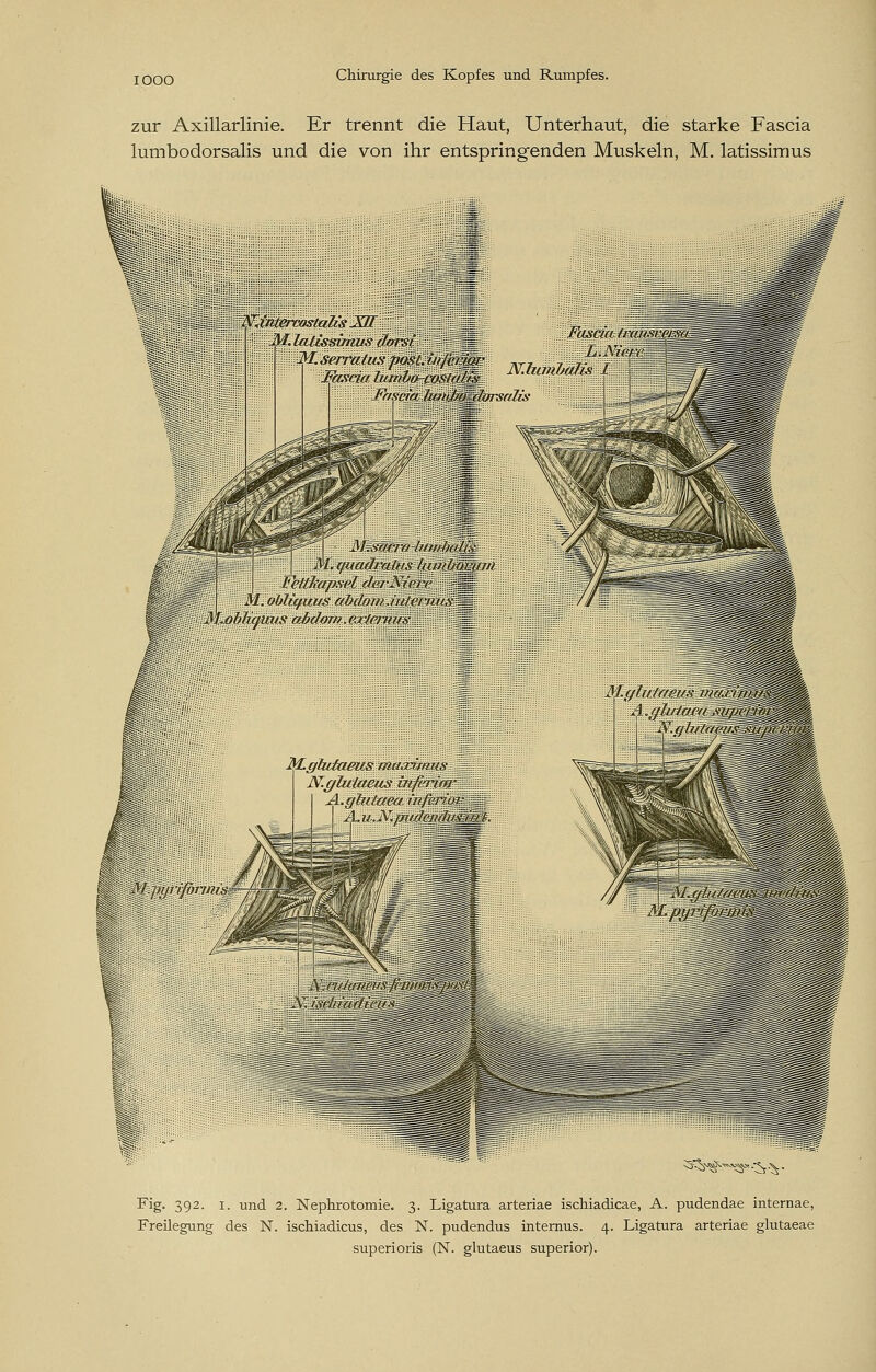 IOOO zur Axillarlinie. Er trennt die Haut, Unterhaut, die starke Fascia lumbodorsalis und die von ihr entspringenden Muskeln, M. latissimus s^^-^-v Fig. 392. 1. und 2. Nephrotomie. 3. Ligatura arteriae ischiadicae, A. pudendae internae, Freilegung des N. ischiadicus, des N. pudendus internus. 4. Ligatura arteriae glutaeae superioris (N. glutaeus superior).