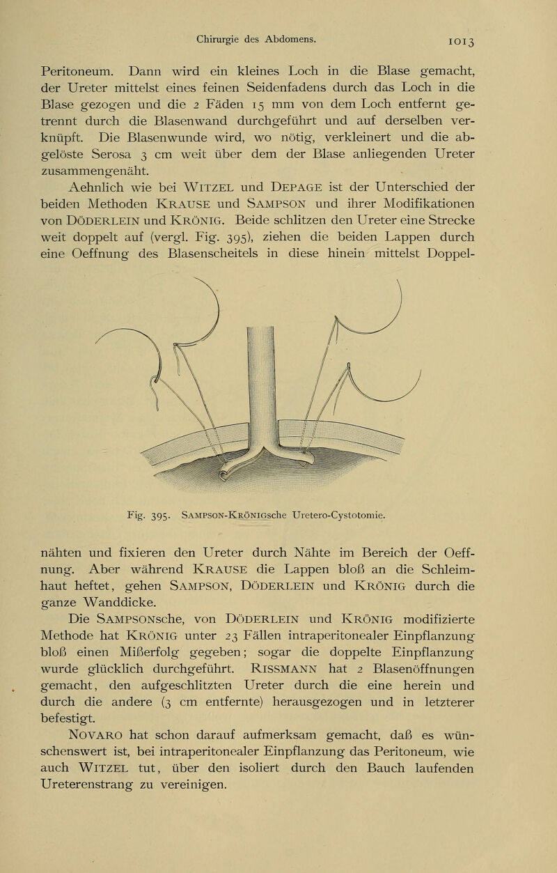 Peritoneum. Dann wird ein kleines Loch in die Blase gemacht, der Ureter mittelst eines feinen Seidenfadens durch das Loch in die Blase gezogen und die 2 Fäden 15 mm von dem Loch entfernt ge- trennt durch die Blasenwand durchgeführt und auf derselben ver- knüpft. Die Blasenwunde wird, wo nötig, verkleinert und die ab- gelöste Serosa 3 cm weit über dem der Blase anliegenden Ureter zusammengenäht. Aehnlich wie bei Witzel und Depage ist der Unterschied der beiden Methoden Krause und Sampson und ihrer Modifikationen von Döderlein und Krönig. Beide schlitzen den Ureter eine Strecke weit doppelt auf (vergl. Fig. 395), ziehen die beiden Lappen durch eine Oeffnung des Blasenscheitels in diese hinein mittelst Doppel- Fig. 395. SAMPSON-KRÖNiGsche Uretero-Cystotomie. nähten und fixieren den Ureter durch Nähte im Bereich der Oeff- nung. Aber während Krause die Lappen bloß an die Schleim- haut heftet, gehen Sampson, Döderlein und Krönig durch die ganze Wanddicke. Die SAMPSONsche, von Döderlein und Krönig modifizierte Methode hat KRÖNIG unter 23 Fällen intraperitonealer Einpflanzung bloß einen Mißerfolg gegeben; sogar die doppelte Einpflanzung wurde glücklich durchgeführt. Rissmann hat 2 Blasenöffnungen gemacht, den aufgeschlitzten Ureter durch die eine herein und durch die andere (3 cm entfernte) herausgezogen und in letzterer befestigt. Novaro hat schon darauf aufmerksam gemacht, daß es wün- schenswert ist, bei intraperitonealer Einpflanzung das Peritoneum, wie auch Witzel tut, über den isoliert durch den Bauch laufenden Ureterenstrang zu vereinigen.