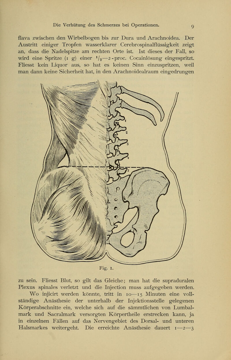 flava zwischen den Wirbelbogen bis zur Dura und Arachnoidea. Der Austritt einiger Tropfen wasserklarer Cerebrospinalflüssigkeit zeigt an, dass die Nadelspitze am rechten Orte ist. Ist dieses der Fall, so wird eine Spritze (i g) einer 1/2—2-proc. Cocainlösung eingespritzt. Fliesst kein Liquor aus, so hat es keinen Sinn einzuspritzen, weil man dann keine Sicherheit hat, in den Arachnoidealraum eingedrungen Fig. i. zu sein. Fliesst Blut, so gilt das Gleiche; man hat die supraduralen Plexus spinales verletzt und die Injection muss aufgegeben werden. Wo injicirt werden könnte, tritt in 10—15 Minuten eine voll- ständige Anästhesie der unterhalb der Injektionsstelle gelegenen Körperabschnitte ein, welche sich auf die sämmtlichen von Lumbal- mark und Sacralmark versorgten Körpertheile erstrecken kann, ja in einzelnen Fällen auf das Nervengebiet des Dorsal- und unteren Halsmarkes weitergeht. Die erreichte Anästhesie dauert 1—2—3