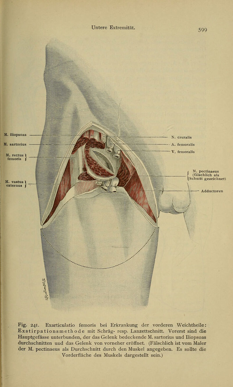 599 N. cruralis A. femoralis V. femoralis C M. pectinaeus ) (fälschlich als ^Schnitt gezeichnet! Adductoren Fig. 241. Exarticulatio femoris bei Erkrankung der vorderen Weichtheile: Exstirpationsmethode mit Schräg- resp. Lanzettschnitt. Vorerst sind die Hauptgefässe unterbunden, der das Gelenk bedeckende M. sartorius und Iliopsoas durchschnitten und das Gelenk von vorneher eröffnet. (Fälschlich ist vom Maler der M. pectinaeus als Durchschnitt durch den Muskel angegeben. Es sollte die Vorderfläche des Muskels dargestellt sein.)