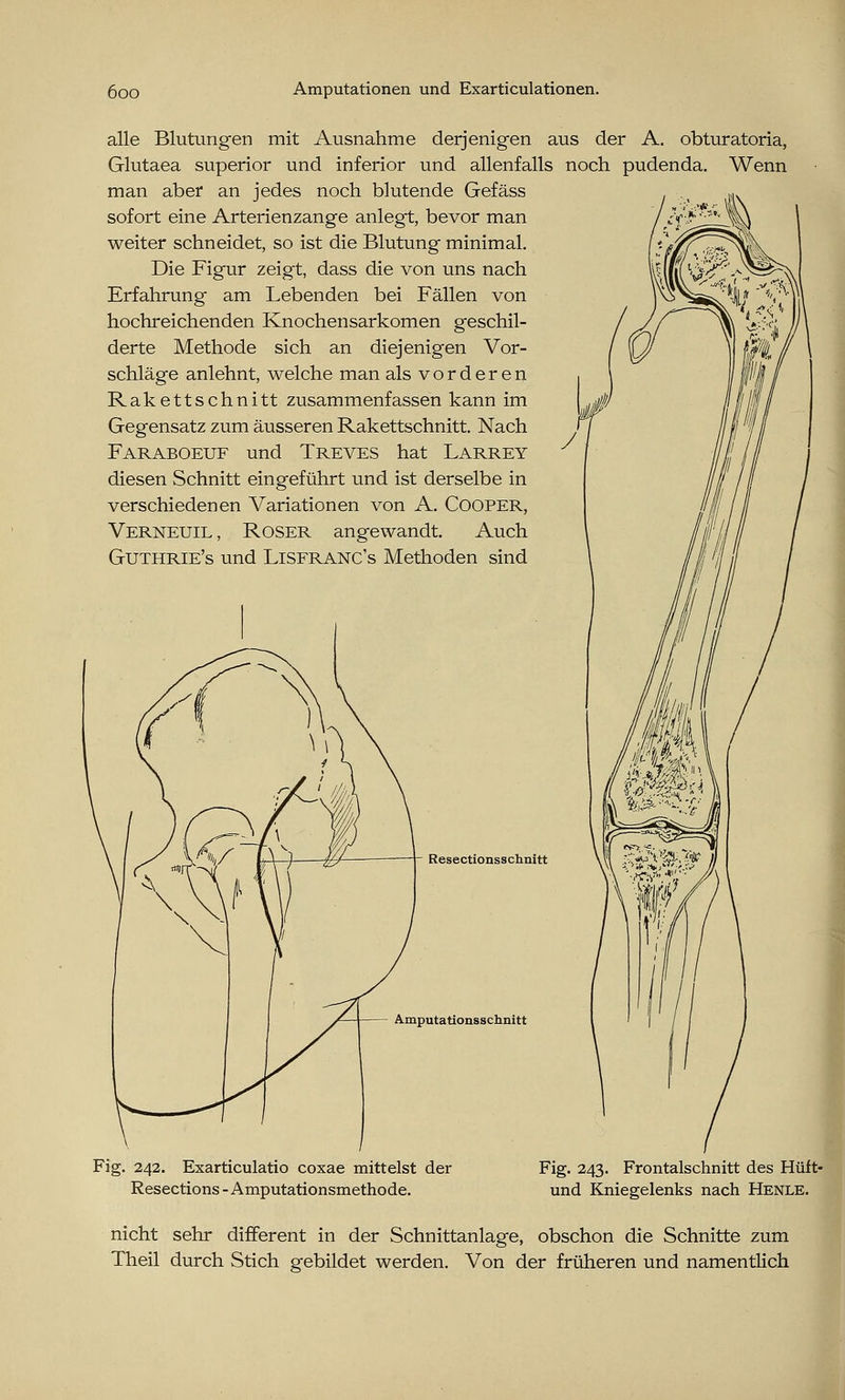 alle Blutungen mit Ausnahme derjenigen aus der A. obturatoria, Glutaea superior und inferior und allenfalls noch pudenda. Wenn man aber an jedes noch blutende Gefäss sofort eine Arterienzange anlegt, bevor man weiter schneidet, so ist die Blutung minimal. Die Figur zeigt, dass die von uns nach Erfahrung am Lebenden bei Fällen von hochreichenden Knochensarkomen geschil- derte Methode sich an diejenigen Vor- schläge anlehnt, welche man als vorderen Rakettschnitt zusammenfassen kann im Gegensatz zum äusseren Rakettschnitt. Nach Faraboeuf und Treves hat Larrey diesen Schnitt eingeführt und ist derselbe in verschiedenen Variationen von A. Cooper, Verneuil, Roser angewandt. Auch Guthrie's und Lisfranc's Methoden sind - Resectionsschnitt Amputationsschnitt Fig. 242. Exarticulatio coxae mittelst der Resections - Amputationsmethode. Fig. 243. Frontalschnitt des Hüft- und Kniegelenks nach Henle. nicht sehr different in der Schnittanlage, obschon die Schnitte zum Theil durch Stich gebildet werden. Von der früheren und namentlich