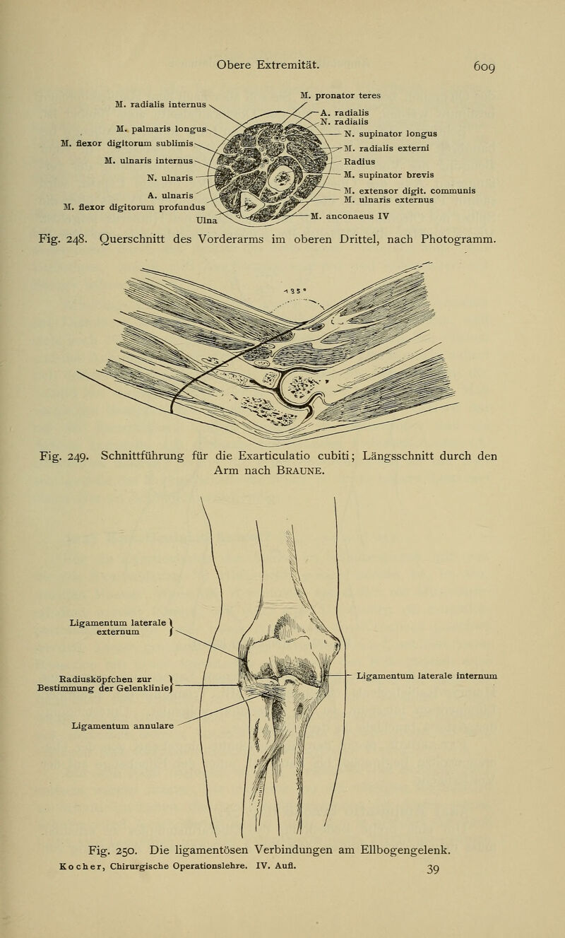 M. radialis internus M. palmaris longus M. flexor digitorum sublimis M. ulnaris internus N. ulnaris A. ulnaris M. flexor digitorum profundus Ulna M. pronator teres A. radialis N. radialis N. supinator longus M. radialis externi Radius M. supinator brevis M. extensor digit. communis M. ulnaris externus Fig. 248. Querschnitt des Vorderarms im oberen Drittel, nach Photogramm. Fig. 249. Schnittführung für die Exarticulatio cubiti; Längsschnitt durch den Arm nach BRAUNE. Ligamentum laterale ~\ externum / Radiusköpfchen zur \ Bestimmung der Gelenklinie/ Ligamentum annulare Ligamentum laterale internum Fig. 250. Die ligamentösen Verbindungen am Ellbogengelenk. Kocher, Chirurgische Operationslehre. IV. Aufl. -?g