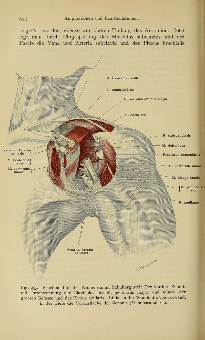 losgelöst werden, ebenso am oberen Umfang des Acromion. Jetzt legt man durch Längsspaltung des Musculus subclavius und der Fascie die Vena und Arteria subclavia und den Plexus brachialis Vena u. Artariaf axillaris \ A. transversa colli ohyoideus . serratus anticus major M. subscapularis M. deltoideus . — Processus coracoideus M. pectoralis minor M. biceps brachii {M. pectoralis major N. medianus Fig. 255. Exarticulation des Armes sammt Schultergürtel: Der vordere Schnitt mit Durchtrennung der Clavicula, des M. pectoralis major und minor, der grossen Gefässe und des Plexus axillaris. Links in der Wunde die Thoraxwand, in der Tiefe die Vordernache der Scapula (M. subscapularis).
