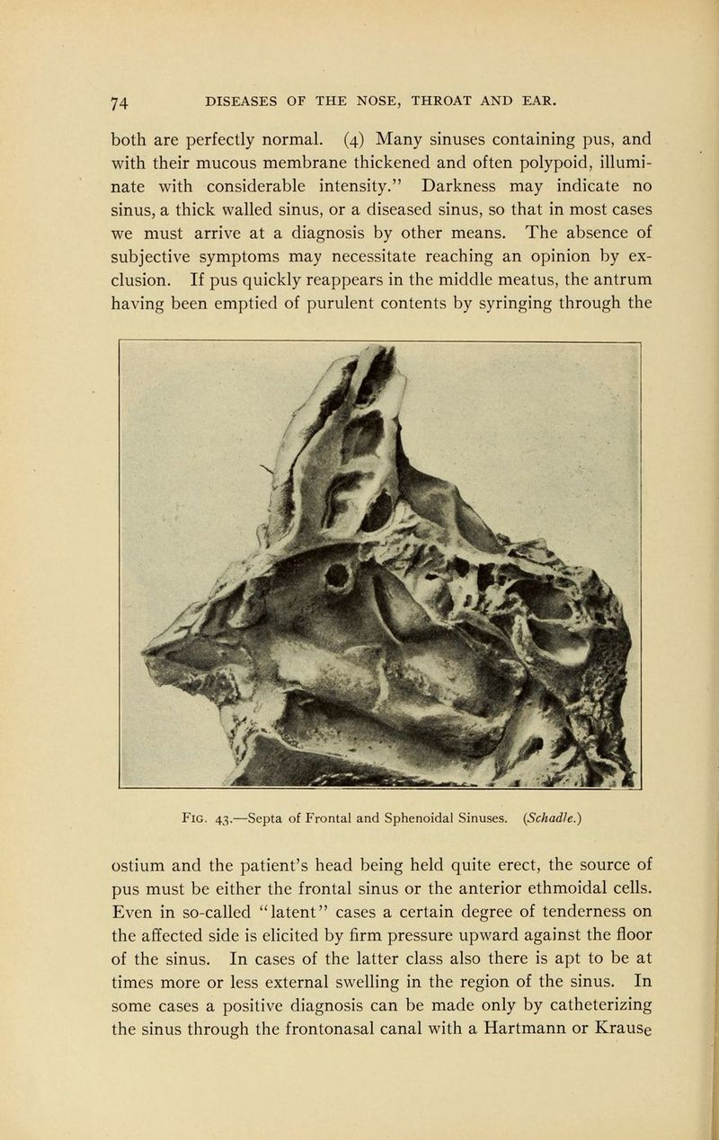 both are perfectly normal. (4) Many sinuses containing pus, and with their mucous membrane thickened and often polypoid, illumi- nate with considerable intensity. Darkness may indicate no sinus, a thick walled sinus, or a diseased sinus, so that in most cases we must arrive at a diagnosis by other means. The absence of subjective symptoms may necessitate reaching an opinion by ex- clusion. If pus quickly reappears in the middle meatus, the antrum having been emptied of purulent contents by syringing through the Fig. 43.—Septa of Frontal and Sphenoidal Sinuses. (Schadle.) ostium and the patient's head being held quite erect, the source of pus must be either the frontal sinus or the anterior ethmoidal cells. Even in so-called latent cases a certain degree of tenderness on the affected side is elicited by firm pressure upward against the floor of the sinus. In cases of the latter class also there is apt to be at times more or less external swelling in the region of the sinus. In some cases a positive diagnosis can be made only by catheterizing the sinus through the frontonasal canal with a Hartmann or Krause