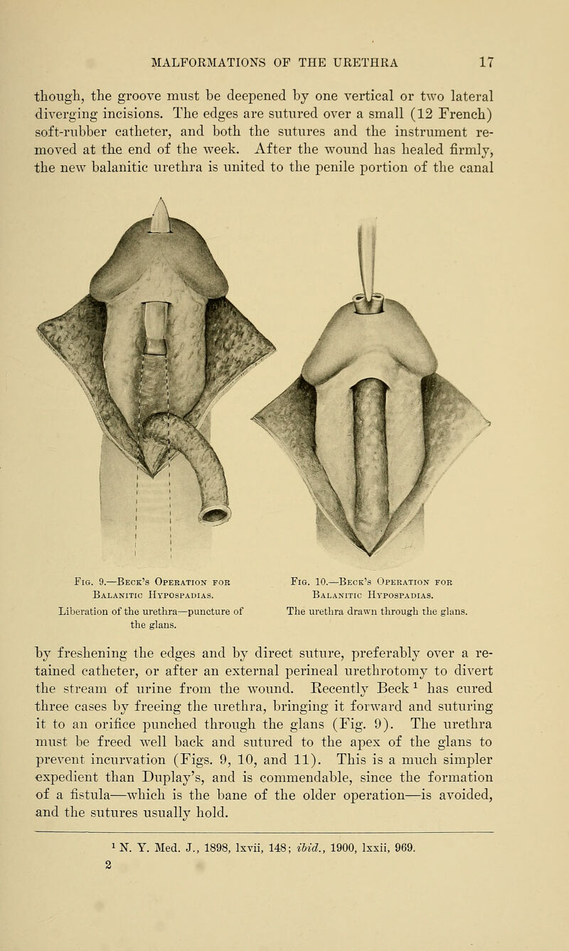 though, the groove must be deepened by one vertical or two lateral diverging incisions. The edges are sutured over a small (12 Trench) soft-rubber catheter, and both the sutures and the instrument re- moved at the end of the week. After the wound has healed firmly, the new balaiiitic urethra is united to the penile portion of the canal Fig. 9.—Beck's Operation foe Balanitic Hypospadias. Liberation of the urethra—puncture of the glans. Fig. 10.—Beck's Operation for Balanitic Hypospadias. The urethra drawn through the glans. by freshening the edges and by direct suture, preferably over a re- tained catheter, or after an external perineal urethrotomy to divert the stream of urine from the wound. Recently Beckl has cured three cases by freeing the urethra, bringing it forward and suturing it to an orifice punched through the glans (Fig. 9). The urethra must be freed well back and sutured to the apex of the glans to prevent incurvation (Figs. 9, 10, and 11). This is a much simpler expedient than Duplay's, and is commendable, since the formation of a fistula—which is the bane of the older operation—is avoided, and the sutures usually hold. 1 N. Y. Med. J., 1898, lxvii, 148; ibid., 1900, lxxii, 969.