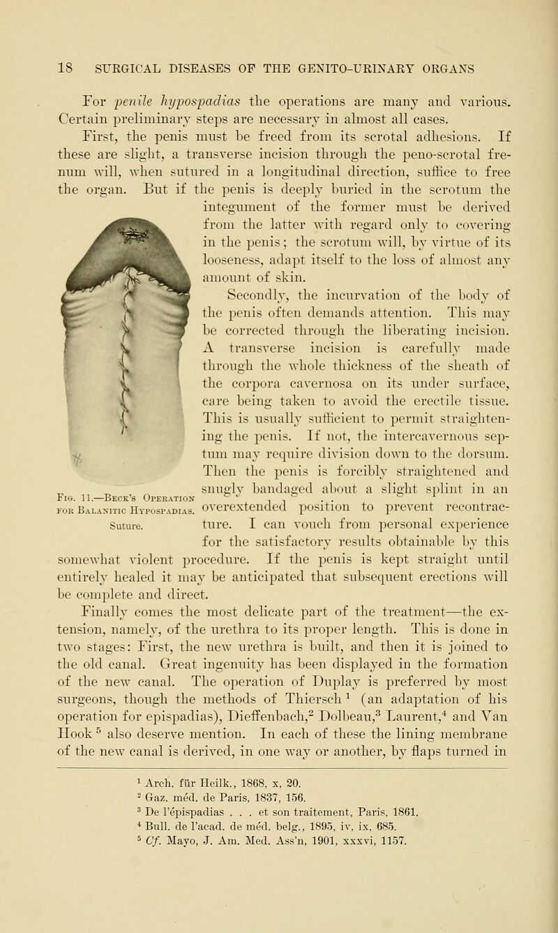 For penile hypospadias the operations are many and various. Certain preliminary steps are necessary in almost all cases. First, the penis must be freed from its scrotal adhesions. If these are slight, a transverse incision through the peno-scrotal fre- num will, when sutured in a longitudinal direction, suffice to free the organ. But if the penis is deeply buried in the scrotum the integument of the former must be derived from the latter with regard only to covering in the penis; the scrotum will, by virtue of its looseness, adapt itself to the loss of almost any amount of skin. Secondly, the incurvation of the body of the penis often demands attention. This may be corrected through the liberating incision. A transverse incision is carefully made through the whole thickness of the sheath of the corpora cavernosa on its under surface, en re being taken to avoid the erectile tissue. This is usually sufficient to permit straighten- ing the penis. If not, the intercavernous sep- tum may require division down to the dorsum. Then the penis is forcibly straightened and snugly bandaged about a slight splint in an Fig. 11.—Beck's Operation b J , , to . . b l fob Ealanitic Hypospadias, overextended position to prevent recontrac- Suture. ture. I can vouch from personal experience for the satisfactory results obtainable by this somewhat violent procedure. If the penis is kept straight until entirely healed it may be anticipated that subsequent erections will be complete and direct. Finally comes the most delicate part of the treatment—the ex- tension, namely, of the urethra to its proper length. This is done in two stages: First, the new urethra is built, and then it is joined to the old canal. Great ingenuity has been displayed in the formation of the new canal. The operation of Duplay is preferred by most surgeons, though the methods of Thiersch 1 (an adaptation of his operation for epispadias), Dieffenbach,2 Dolbeau,3 Laurent,4 and Van Hook 5 also deserve mention. In each of these the lining membrane of the new canal is derived, in one way or another, by flaps turned in 1 Arch, fur Heilk., 1868, x, 20. 2 Gaz. med. de Paris, 1837, 156. 3 De l'epispadias . . . et son traitement, Paris, 1861. i Bull, de l'acad. de med. belg., 1895, iv, ix, 685. 5 Cf. Mayo, J. Am. Med. Ass'n, 1901, xxxvi, 1157.