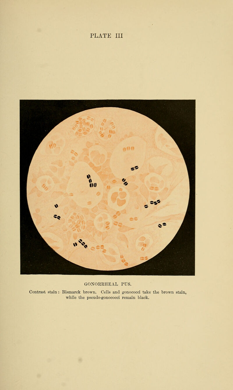GONORRHEAL PUS. Contrast stain: Bismarck brown. Cells and gonococci take the brown stain, while the pseudo-gonococci remain black.