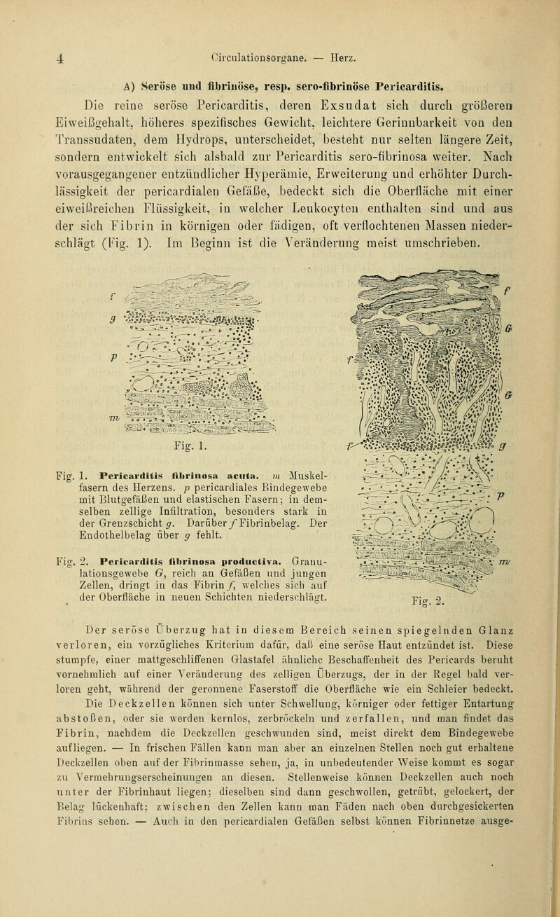 A) Seröse und fibrinöse, resp. sero-fibrinöse Pericarditis. Die reine seröse Pericarditis, deren Exsudat sicli durch größereo Eiweißgehalt, höheres spezifisches Gewicht, leichtere Gerinnbarkeit von dea Transsudaten, dem Hydrops, unterscheidet, besteht nur selten längere Zeit, sondern entwickelt sich alsbald zur Pericarditis sero-fibrinosa weiter. Nach vorausgegangener entzündlicher Hyperämie, Erweiterung und erhöhter Durch- lässigkeit der pericardialen Gefäße, bedeckt sich die Oberfläche mit einer eiweißreichen Flüssigkeit, in welcher Leukocyten enthalten sind und aus der sich Fibrin in körnigen oder fadigen, oft verflochtenen Massen nieder- schlägt (Fig. 1). Im Beginn ist die Veränderung meist umschrieben. i) •j?,%i.->'^° .'''• i-''ä'5i-*'if»<iw.slÄ'■ 'o?- -e^-.:: v% Fig. 1. Fig. 1. Pericarditis fibrinosa acuta, m Muskel- fasern des Herzens, p pericardiales Bindegewebe mit Blutgefäßen und elastischen Fasern; in dem- selben zellige Infiltration, besonders stark in der Grenzschicht ^r. Darüber/Fibrinbelag. Der Endothelbelag über g fehlt. Fig. 2. Pericarditis fibrinosa productiva. Granu- lationsgewebe G, reich an Gefäßen und jungen Zellen, dringt in das Fibrin/, welches sich auf der Oberfläche in neuen Schichten niederschlägt. Fig. 2. Der seröse Überzug hat in diesem Bereich seinen spiegelnden Glanz verloren, ein vorzügliches Kriterium dafür, daß eine seröse Haut entzündet ist. Diese stumpfe, einer mattgeschliffenen Glastafel ähnliche Beschaifenheit des Pericards beruht vornehmlich auf einer Veränderung des zelligen Überzugs, der in der Regel bald ver- loren geht, während der geronnene Faserstoff die Oberfläche wie ein Schleier bedeckt. Die Deckzellen können sich unter Schwellung, körniger oder fettiger Entartung abstoßen, oder sie werden kernlos, zerbröckeln und zerfallen, und man findet das Fibrin, nachdem die Deckzellen geschwunden sind, meist direkt dem Bindegewebe aufliegen. — In frischen Fällen kann man aber an einzelnen Stellen noch gut erhaltene Deckzellen oben auf der Fibrinmasse sehen, ja, in unbedeutender Weise kommt es sogar zu Vermehrungserscheinungen an diesen. Stellenweise können Deckzellen auch noch unter der Fibrinhaut liegen; dieselben sind dann geschwollen, getrübt, gelockert, der Belag lückenhaft: zwischen den Zellen kann man Fäden nach oben durchgesickerten Fibrins sehen. — Auch in den pericardialen Gefäßen selbst können Fibrinnetze ausge-