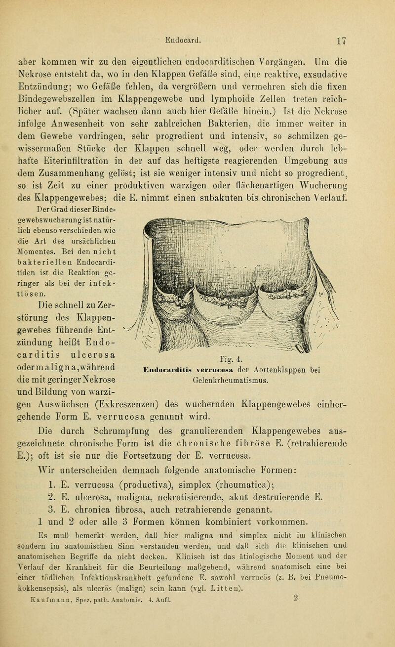 aber kommen wir zu den eigeDtlichen endocarditischen Vorgängen. Um die Nekrose entstellt da, wo in den Klappen Gefäße sind, eine reaktive, exsudative Entzündung; wo Gefäße fehlen, da vergrößern und vermehren sich die fixen Bindegewebszellen im Klappengewebe und lymphoide Zellen treten reich- licher auf. (Später wachsen dann auch hier Gefäße hinein.) Ist die Nekrose infolge Anwesenheit von sehr zahlreichen Bakterien, die immer weiter in dem Gewebe vordringen, sehr progredient und intensiv, so schmilzen ge- wissermaßen Stücke der Klappen schnell weg, oder werden durch leb- hafte Eiterinfiltration in der auf das heftigste reagierenden Umgebung aus dem Zusammenhang gelöst; ist sie weniger intensiv und nicht so progredient, so ist Zeit zu einer produktiven warzigen oder flächenartigen Wucherung des Klappengewebes; die E. nimmt einen subakuten bis chronischen Verlauf. Der Grad dieser Binde- gewebswucherungist natür- lich ebenso Yerschieden wie die Art des ursächlichen Momentes. Bei den nicht bakteriellen Endocardi- tiden ist die Reaktion ge- ringer als bei der infek- tiösen. Die schnell zu Zer- störung des Klappen- gewebes führende Ent- zündung heißt Endo- carditis ulcerosa oder malig na,während die mit geringer Nekrose und Bildung von warzi- gen Auswüchsen (Exkreszenzen) des wuchernden Klappengewebes einher- gehende Form E. verrucosa genannt wird. Die durch Schrumpfung des granulierenden Klappengewebes aus- gezeichnete chronische Form ist die chronische fibröse E. (retrahierende E.); oft ist sie nur die Fortsetzung der E. verrucosa. Wir unterscheiden demnach folgende anatomische Formen: 1. E. verrucosa (productiva), simplex (rheumatica); 2. E. ulcerosa, maligna, nekrotisierende, akut destruierende E. 3. E. chronica fibrosa, auch retrahierende genannt. 1 und 2 oder alle 3 Formen können kombiniert vorkommen. Es miiü bemerkt werden, daß hier maligna und simplex nicht im klinischen sondern im anatomischen Sinn verstanden werden, und daß sich die klinischen und anatomischen Begriffe da nicht decken. Klinisch ist das ätiologische Moment und der Verlauf der Krankheit für die Beurteilung maßgebend, während anatomisch eine bei einer tödlichen Infektionskrankheit gefundene E. sowohl verrucös (z. B. bei Pneumo- kokkensepsis), als iilcerös (malign) sein kann (vgl. Litten). Kaufmann, Spez. patb. Anatomie. 4. Auf). ■ Fig. 4. Eiidocarditis verrucosa der Aortenklappen bei Gelenkrheumatismus.