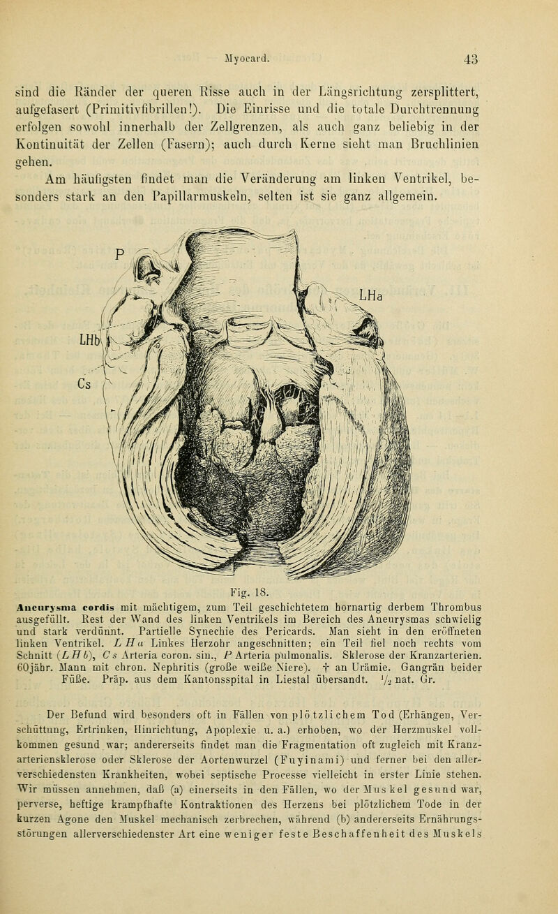 sind die Ränder der queren Risse auch in der Längsrichtung zersplittert, aufgefasert (Primitivfihrillen!). Die Einrisse und die totale Durchtrennung erfolgen sowohl innerhalb der Zellgrenzen, als auch ganz beliebig in der Kontinuität der Zellen (Fasern); auch durch Kerne sieht man Bruchlinien gehen. Am häufigsten findet man die Veränderung am linken Ventrikel, be- sonders stark an den Papillarmuskelu, selten ist sie ganz allgemein. Fig. 18. Aueurysma cordis mit mächtigem, zum Teil geschichtetem hornartig derbem Thrombus ausgefüllt. Rest der Wand des linken Ventrikels im Bereich des Aneurysmas schwielig und stark verdünnt. Partielle Synechie des Pericards. Man sieht in den eröffneten linken Ventrikel. LHa Linkes Herzohr angeschnitten; ein Teil fiel noch rechts vom Schnitt (LHb), Cs Arteria coron. sin., P Arteria pulmonalis. Sklerose der Kranzarterien. GOjähr. Mann mit chron. Nephritis (große weiße Niere), f an Urämie. Gangrän beider Füße. Präp. aus dem Kantonsspital in Liestal übersandt. V2 nat. Gr. Der Befund wird besonders oft in Fällen von plö tzli ehern Tod (Erhängen, Ver- schüttung, Ertrinken, Hinrichtung, Apoplexie u. a.) erhoben, wo der Herzmuskel voll- kommen gesund war; andererseits findet man die Fragmentation oft zugleich mit Kranz- arteriensklerose oder Sklerose der Aortenwurzel (Fuyinami) und ferner bei den aller- verschiedensten Krankheiten, wobei septische Processe vielleicht in erster Linie stehen. Wir müssen annehmen, daß (a) einerseits in den Fällen, wo der Muskel gesund war, perA-erse, heftige krampfhafte Kontraktionen des Herzens bei plötzlichem Tode in der kurzen Agone den Muskel mechanisch zerbrechen, während (b) andererseits Ernährungs- stöningen allerverschiedenster Art eine weniger feste Beschaffenheit des Muskels