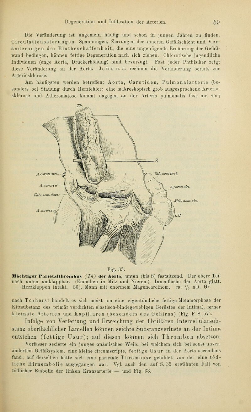 Die Veränderung ist ungemein häufig und schon in jungen Jahren zu finden. Circulationsstörungeu. Spannungen, Zerrungen der inneren Gefäßschicht und Ver- änderungen der Blutbeschaffeuh eit, die eine ungenügende Ernährung der Gefäß- wand bedingen, können fettige Degeneration nach sich ziehen. Chlorotische jugendliche Individuen (enge Aorta, Druckerhöhung) sind bevorzugt. Fast jeder Phthisiker zeigt diese Veränderung an der Aorta. Jores u. a. rechnen die Veränderung bereits zur Arteriosklerose. Am häufigsten werden betroffen: Aorta, Carotiden, Pulmonalarterie (be- sonders bei Stauung durch Herzfehler; eine makroskopisch grob ausgesprochene Arterio- sklerose und Atheromatose kommt dagegen an der Arteria pulmonalis fast nie vor; se^npost Falv. T^v. seTn.süh. ^LE Fig. 33. Mächtiger Parietalthroinbus (Th) der Aorta, unten (bis S) festsitzend. Der obere Teil nach unten umklappbar. (Embolien in Milz und Nieren.) Innenfläche der Aorta glatt. Herzklappen intakt. 56j. Mann mit enormem Magencarcinom. ca. ^3 nat. Gr. nach Torhorst handelt es sich meist um eine eigentümliche fettige Metamorphose der Kittsubstanz des primär verdickten elastisch-bindegewebigen Gerüstes der Intima), ferner kleinste Arterien und Kapillaren (.besonders des Gehirns) (Fig. F S. 57). Infolge von Verfettung und Erweichung der fibrillären Intercellularsub- stanz oberflächlicher Lamellen können seichte Substanzverluste an der Intima entstehen (fettige Usur); auf diesen können sich Thromben absetzen. Verfasser secierte ein junges anämisches Weib, bei welchem sich bei sonst unver- ändertem Gefäßsystem, eine kleine circumscripte, fettige Usur in der Aorta ascendens fand: auf derselben hatte sich eine parietale Thrombose gebildet, von der eine töd- liche Hirnembolie ausgegangen war. Vgl. auch den auf S. 35 erwähnten Fall von tödlicher Embolie der linken Kranzarterie — und Fig. 33.