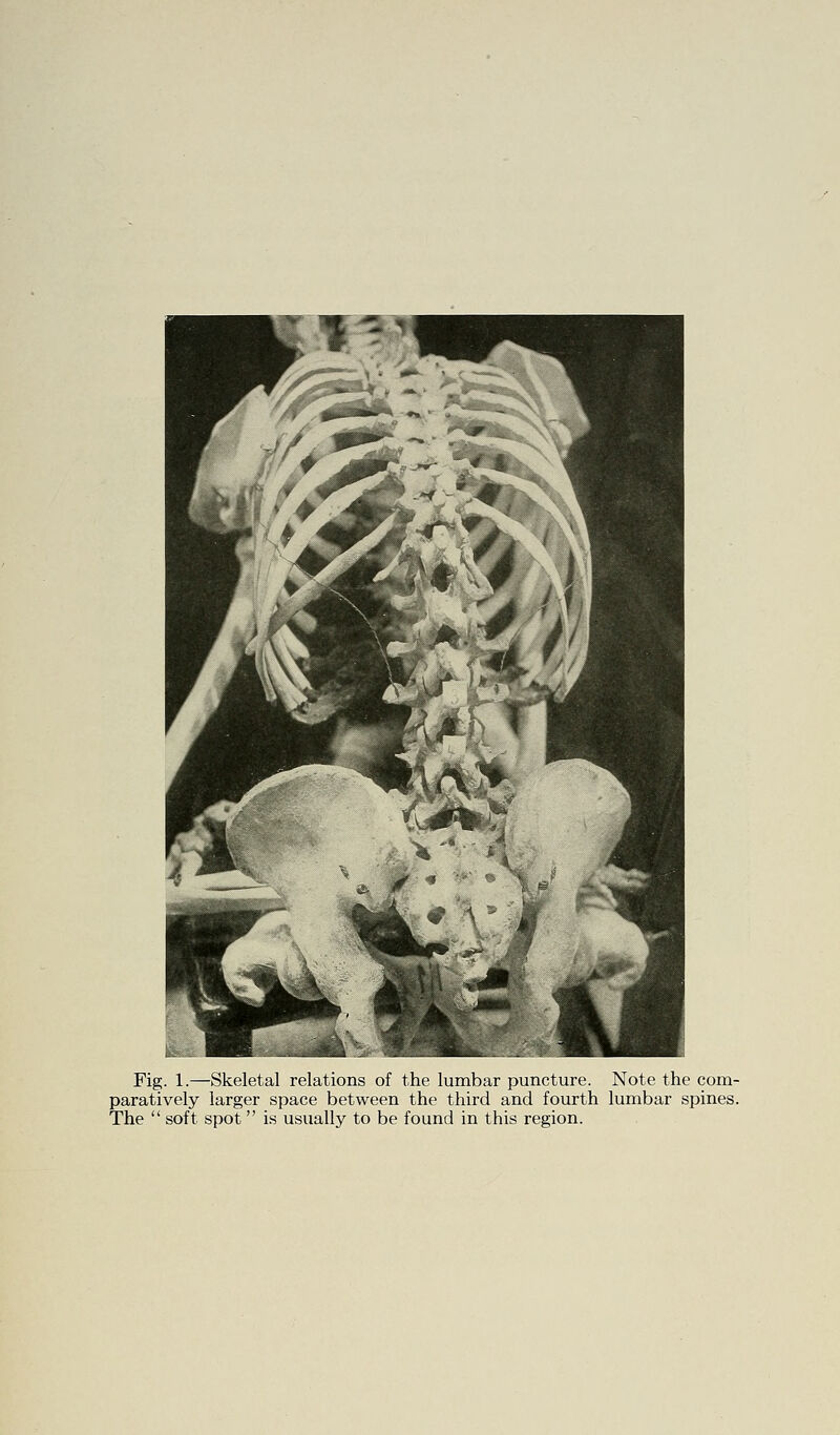 Fig. 1.—Skeletal relations of the lumbar puncture. Note the com- paratively larger space between the third and fourth lumbar spines. The  soft spot is usually to be found in this region.