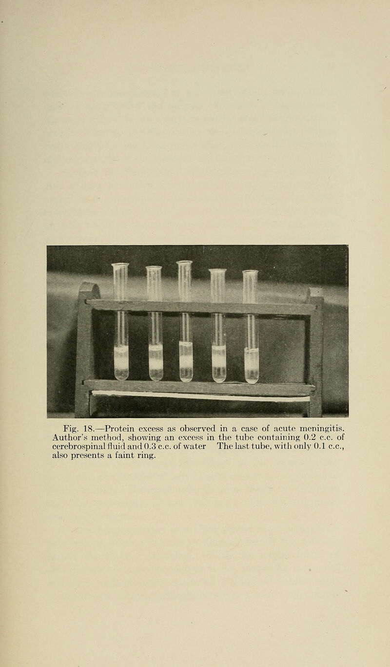 Fig. 18.—Protein excess as observed in a case of acute meningitis. Author's method, showing an excess in the t\ibe containing 0.2 c.c. of cerebrospinal fluid and 0.3 c.c. of water The last tube, with only 0.1 c.c, also presents a faint ring.