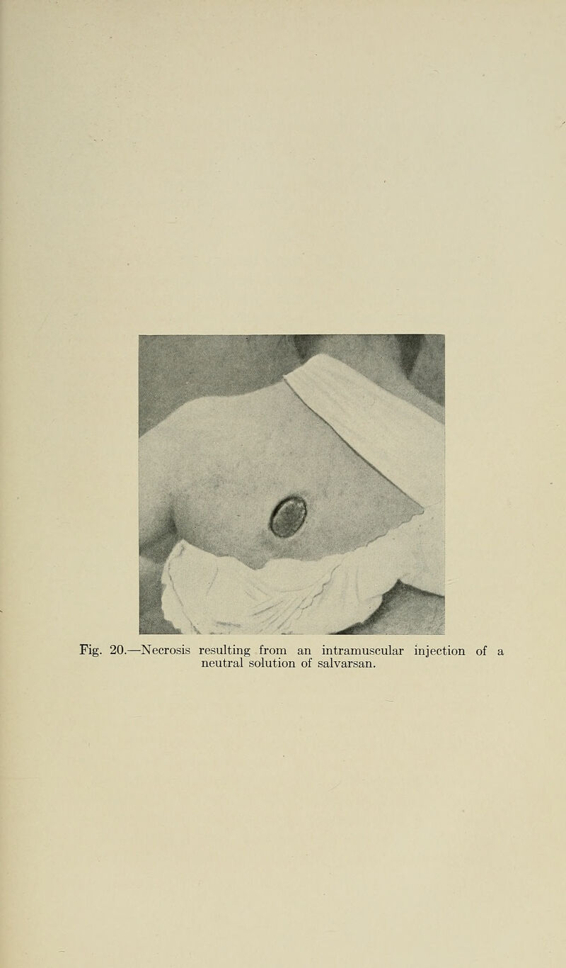 Fig. 20.—Necrosis resulting from an intramuscular injection of a neutral solution of salvarsan.