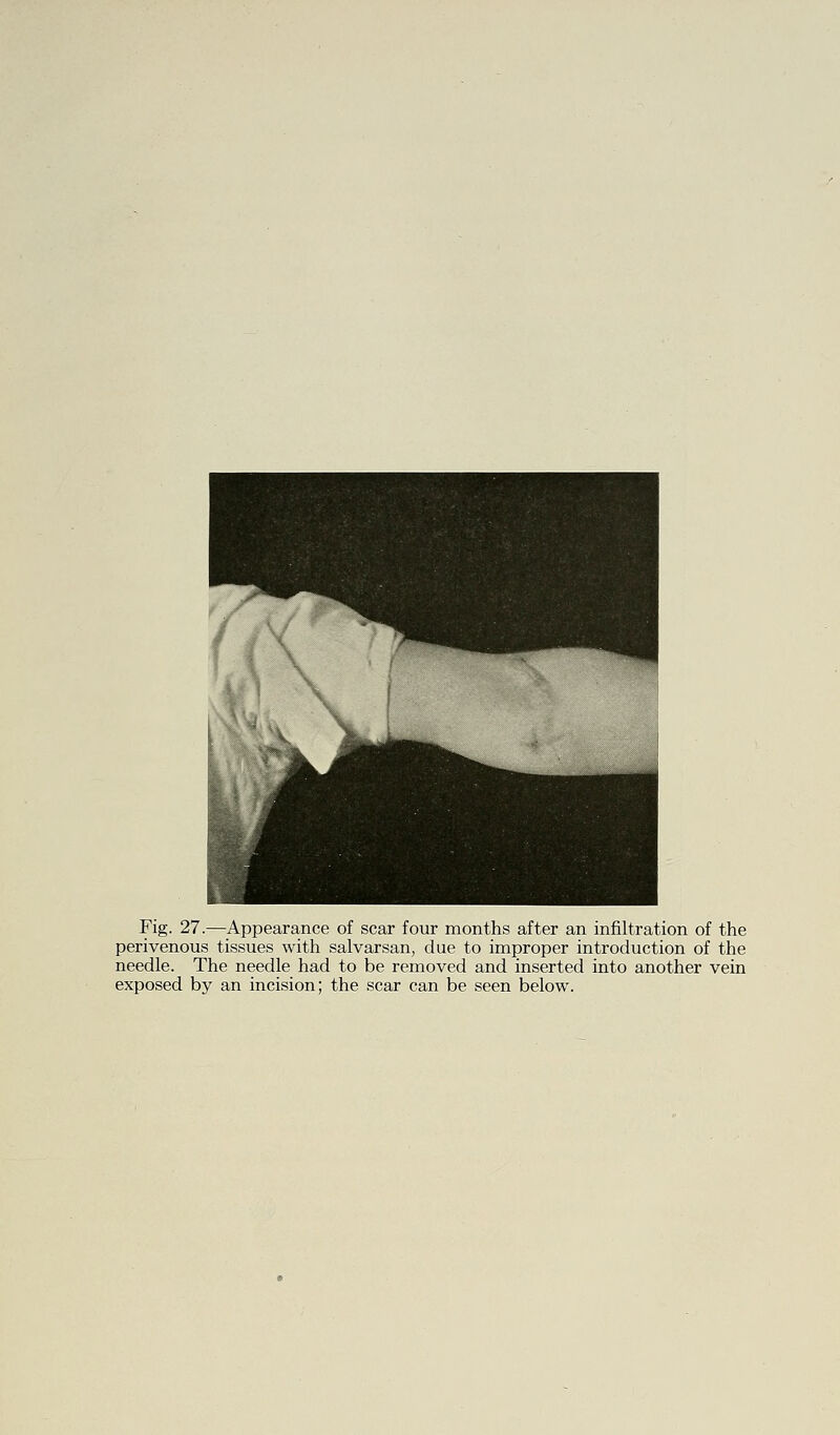 Fig. 27.—Appearance of scar four months after an infiltration of the perivenous tissues with salvarsan, due to improper introduction of the needle. The needle had to be removed and inserted into another vein exposed by an incision; the scar can be seen below.