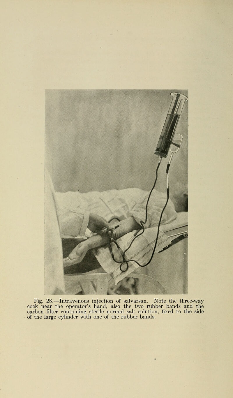 Fig. 28.—Intravenous injection of salvarsan. Note the three-way cock near the operator's hand, also the two rubber bands and the carbon filter containing sterile normal salt solution, fixed to the side of the large cylinder with one of the rubber bands.