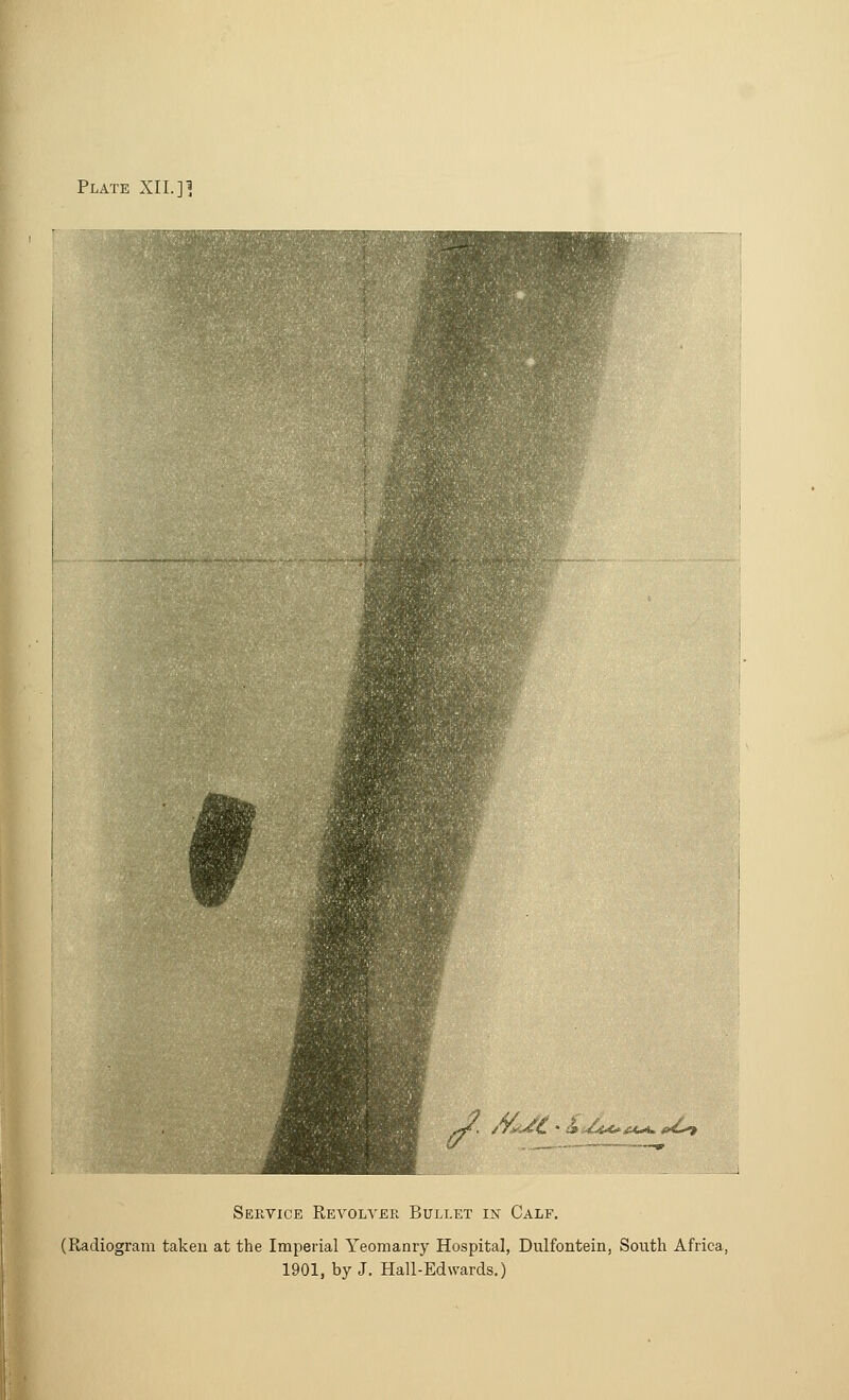 Service Revolver Bullet in Calf. (Radiogram taken at the Imperial Yeomanry Hospital, Dulfontein, South Africa, 1901, by J. Hall-Edwards.)