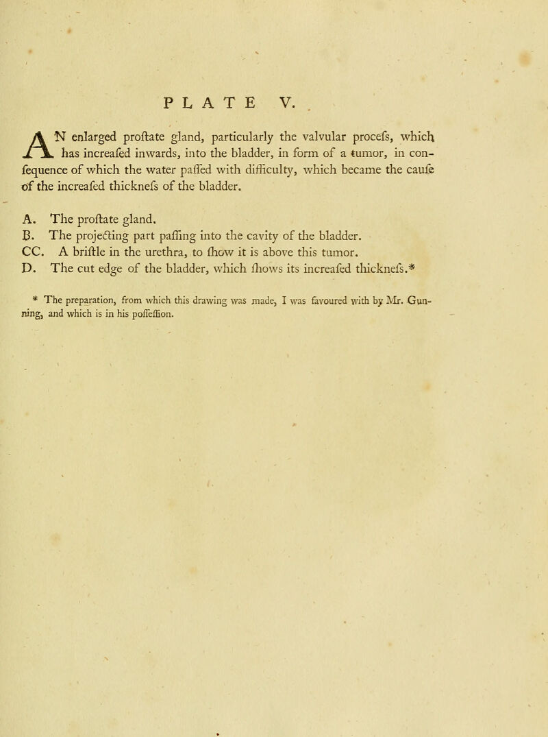 PLATE V. . AN enlarged proftate gland, particularly the valvular procefs, vi^hich has increafed inwards, into the bladder, in form of a tumor, in con- fequence of which the water paffed with difficulty, which became the caufe of the increafed thicknefs of the bladder. A. The proftate gland, B. The projecting part paffing into the cavity of the bladder. CC. A briftle in the urethra, to fhow it is above this tumor. D. The cut edge of the bladder, which fhows its increafed thicknefs.* * The preparation, from which this drawing was made, I was favoured with by A'Ir. Gun- ning, and which is in his pofleffion.