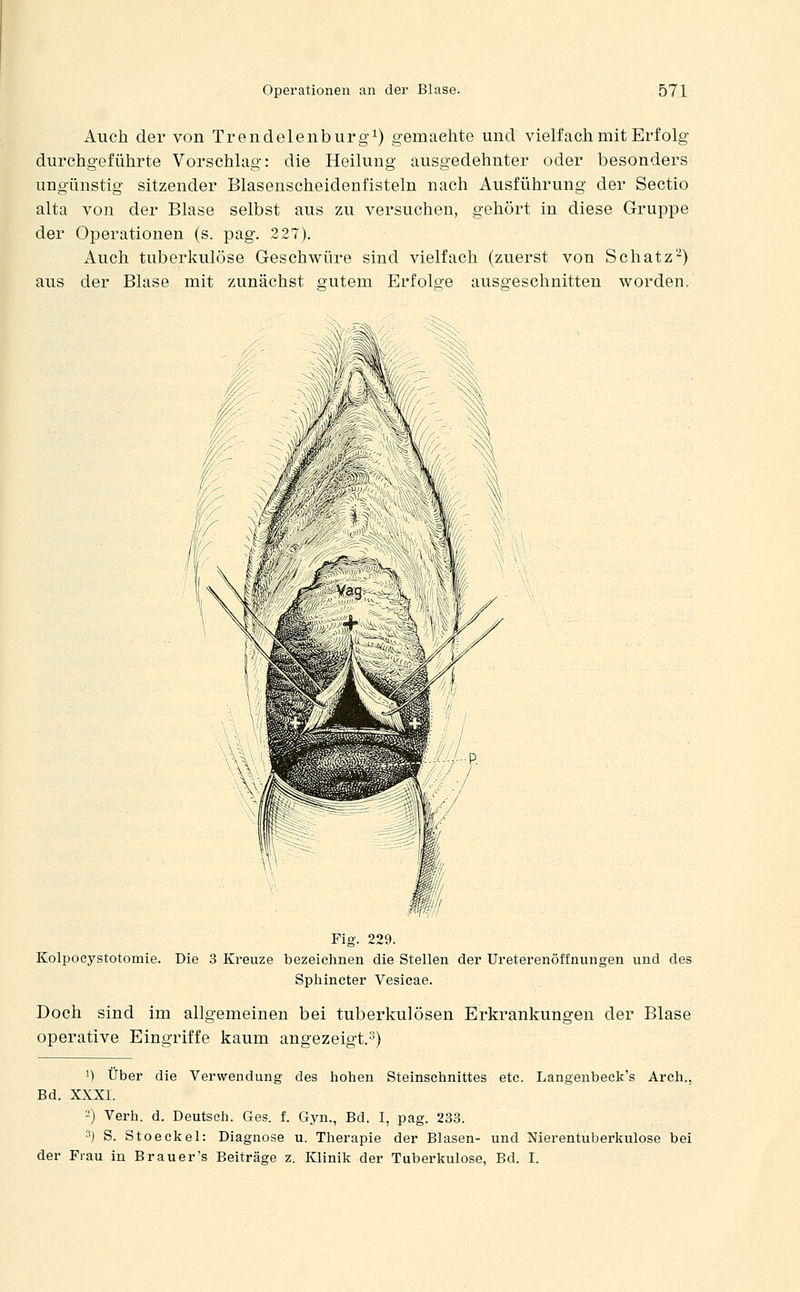 Auch der von Trendelenburg^) gemaehte und vielfach mit Erfolg- durchgeführte Vorschlag: die Heilung ausgedehnter oder besonders ungünstig sitzender Blasenscheidenfisteln nach Ausführung der Sectio alta von der Blase selbst aus zu versuchen, gehört in diese Gruppe der Operationen (s. pag. 227). Auch tuberkulöse Geschwüre sind vielfach (zuerst von Schatz'-^) aus der Blase mit zunächst gutem Erfolge ausgeschnitten worden. Fig. 229. Kolpocystotomie. Die 3 Kreuze bezeichnen die Stellen der Ureterenöffnungen und des Sphincter Vesicae. Doch sind im allgemeinen bei tuberkulösen Erkrankungen der Blase operative Eingriffe kaum angezeigt.^) 1) Über die Verwendung des hohen Steinschnittes etc. Langenbeck's Arch., Bd. XXXL 2) Verh. d. Deutsch. Ges. f. Gyn., Bd. I, pag. 233. 3) S. Stoeckel: Diagnose u. Therapie der Blasen- und Nierentuberkulose bei der Frau in Brauer's Beiträge z. Klinik der Tuberkulose, Bd. I.