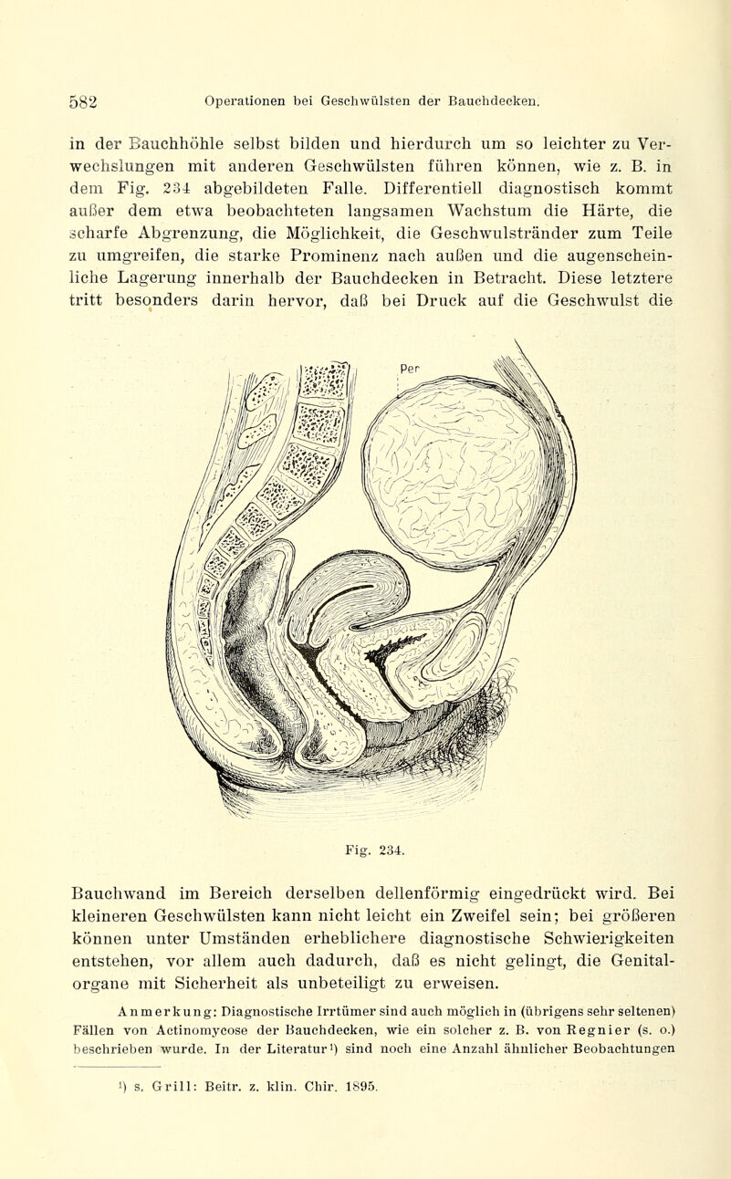 in der Bauchhöhle selbst bilden und hierdurch um so leichter zu Ver- wechslungen mit anderen Geschwülsten führen können, wie z. B. in dem Fig. 234 abgebildeten Falle. Differentiell diagnostisch kommt außer dem etwa beobachteten langsamen Wachstum die Härte, die scharfe Abgrenzung, die Möglichkeit, die Geschwulstränder zum Teile zu umgreifen, die starke Prominenz nach außen und die augenschein- liche Lagerung innerhalb der Bauchdecken in Betracht. Diese letztere tritt besonders darin hervor, daß bei Druck auf die Geschwulst die Fig. 234. Bauchwand im Bereich derselben dellenförmig eingedrückt wird. Bei kleineren Geschwülsten kann nicht leicht ein Zweifel sein; bei größeren können unter Umständen erheblichere diagnostische Schwierigkeiten entstehen, vor allem auch dadurch, daß es nicht gelingt, die Genital- organe mit Sicherheit als unbeteiligt zu erweisen. Anmerkung: Diagnostische Irrtümer sind auch möglich in (übrigens sehr seltenen) Fällen von Actinomycose der Bauchdecken, wie ein solcher z. B. von Regnier (s. o.) beschrieben wurde. In der Literatur^) sind noch eine Anzahl ähnlicher Beobachtungen 1) s. Grill: Beitr. z. klin. Chir. 1895.