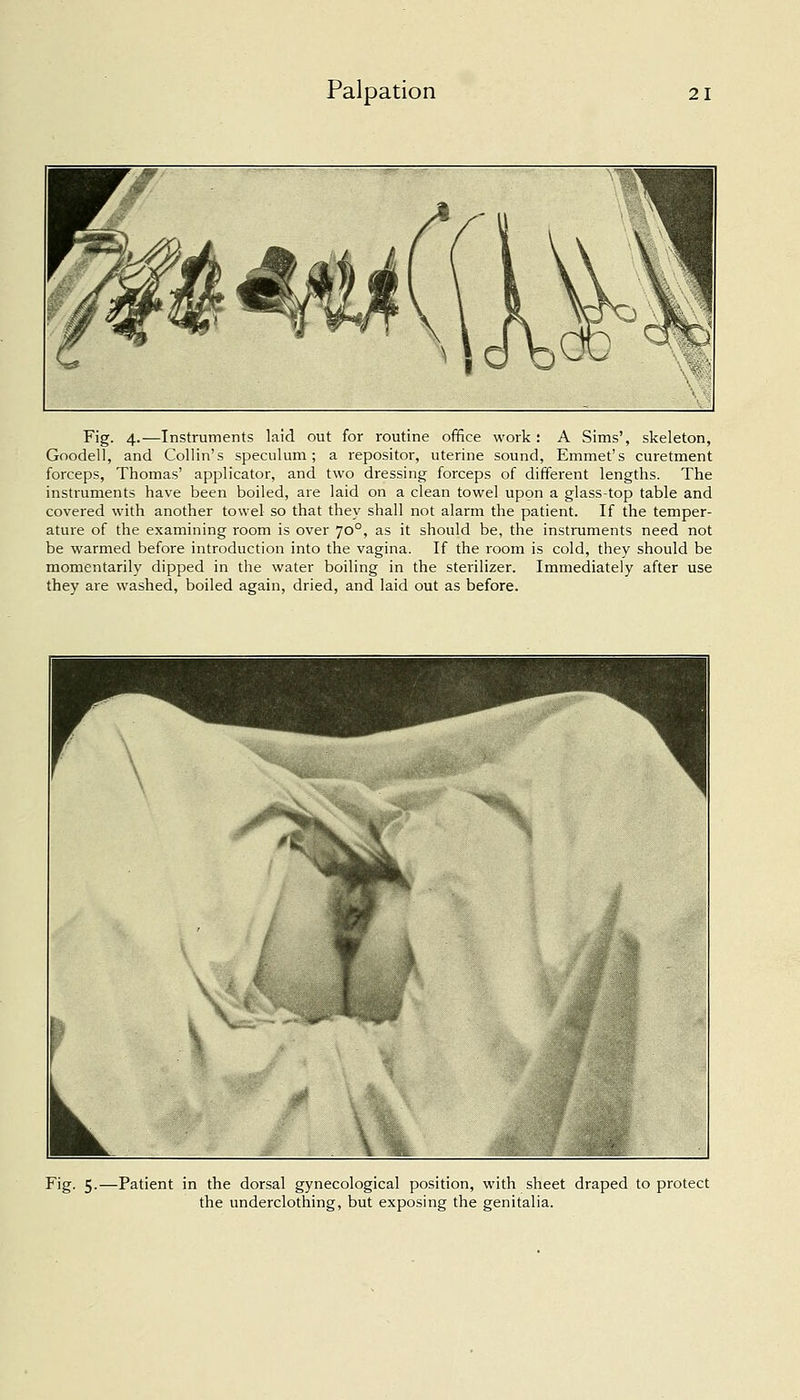Fig. 4.—Instruments laid out for routine office work: A Sims', skeleton, Goodell, and Collin's speculum; a repositor, uterine sound, Emmet's curetment forceps, Thomas' applicator, and two dressing forceps of different lengths. The instruments have been boiled, are laid on a clean towel upon a glass-top table and covered with another towel so that they shall not alarm the patient. If the temper- ature of the examining room is over 700, as it should be, the instruments need not be warmed before introduction into the vagina. If the room is cold, they should be momentarily dipped in the water boiling in the sterilizer. Immediately after use they are washed, boiled again, dried, and laid out as before. Fig. 5.—Patient in the dorsal gynecological position, with sheet draped to protect the underclothing, but exposing the genitalia.