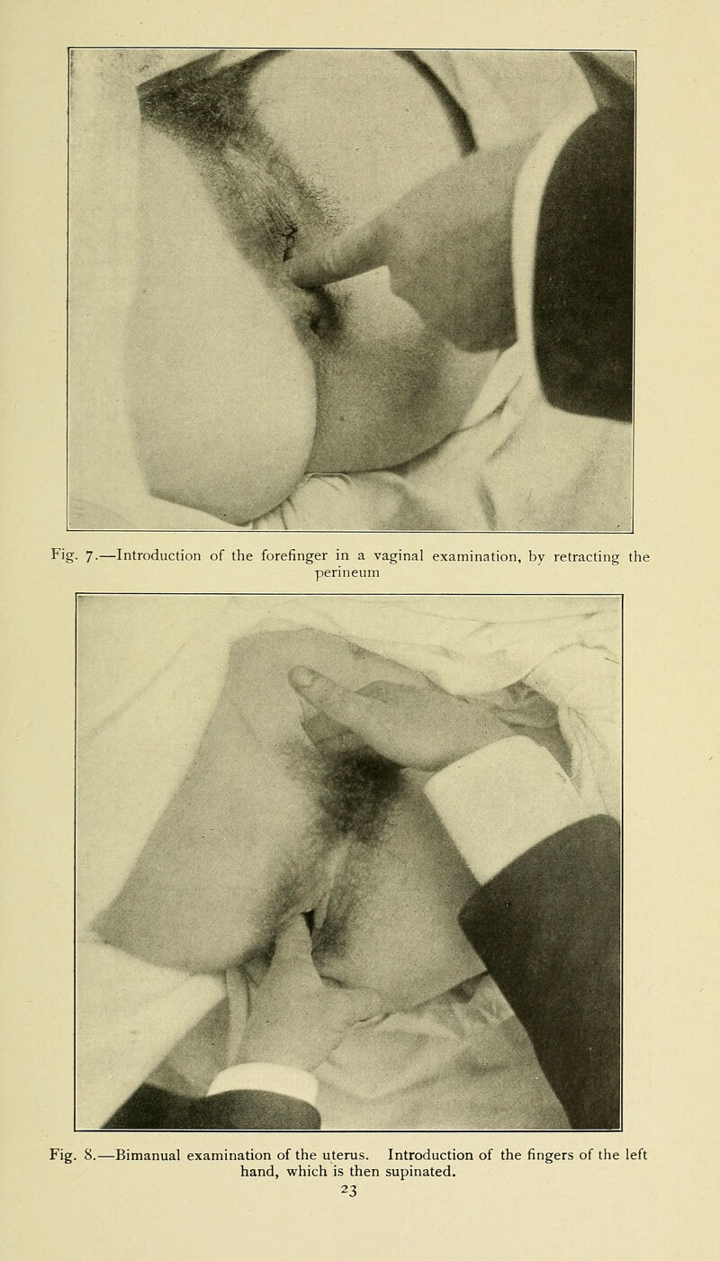 Fig. 7.—Introduction of the forefinger in a vaginal examination, by retracting the perineum Fig. 8.—Bimanual examination of the uterus. Introduction of the fingers of the left hand, which is then supinated.