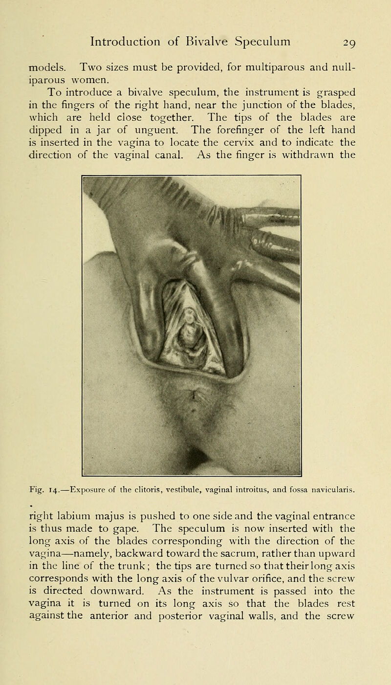 models. Two sizes must be provided, for muciparous and null- iparous women. To introduce a bivalve speculum, the instrument is grasped in the fingers of the right hand, near the junction of the blades, which are held close together. The tips of the blades are dipped in a jar of unguent. The forefinger of the left hand is inserted in the vagina to locate the cervix and to indicate the direction of the vaginal canal. As the finger is withdrawn the Fig. 14.—Exposure of the clitoris, vestibule, vaginal introitus, and fossa navicularis. right labium majus is pushed to one side and the vaginal entrance is thus made to gape. The speculum is now inserted with the long axis of the blades corresponding with the direction of the vagina—namely, backward toward the sacrum, rather than upward in the line of the trunk; the tips are turned so that their long axis corresponds with the long axis of the vulvar orifice, and the screw is directed downward. As the instrument is passed into the vagina it is turned on its long axis so that the blades rest against the anterior and posterior vaginal walls, and the screw